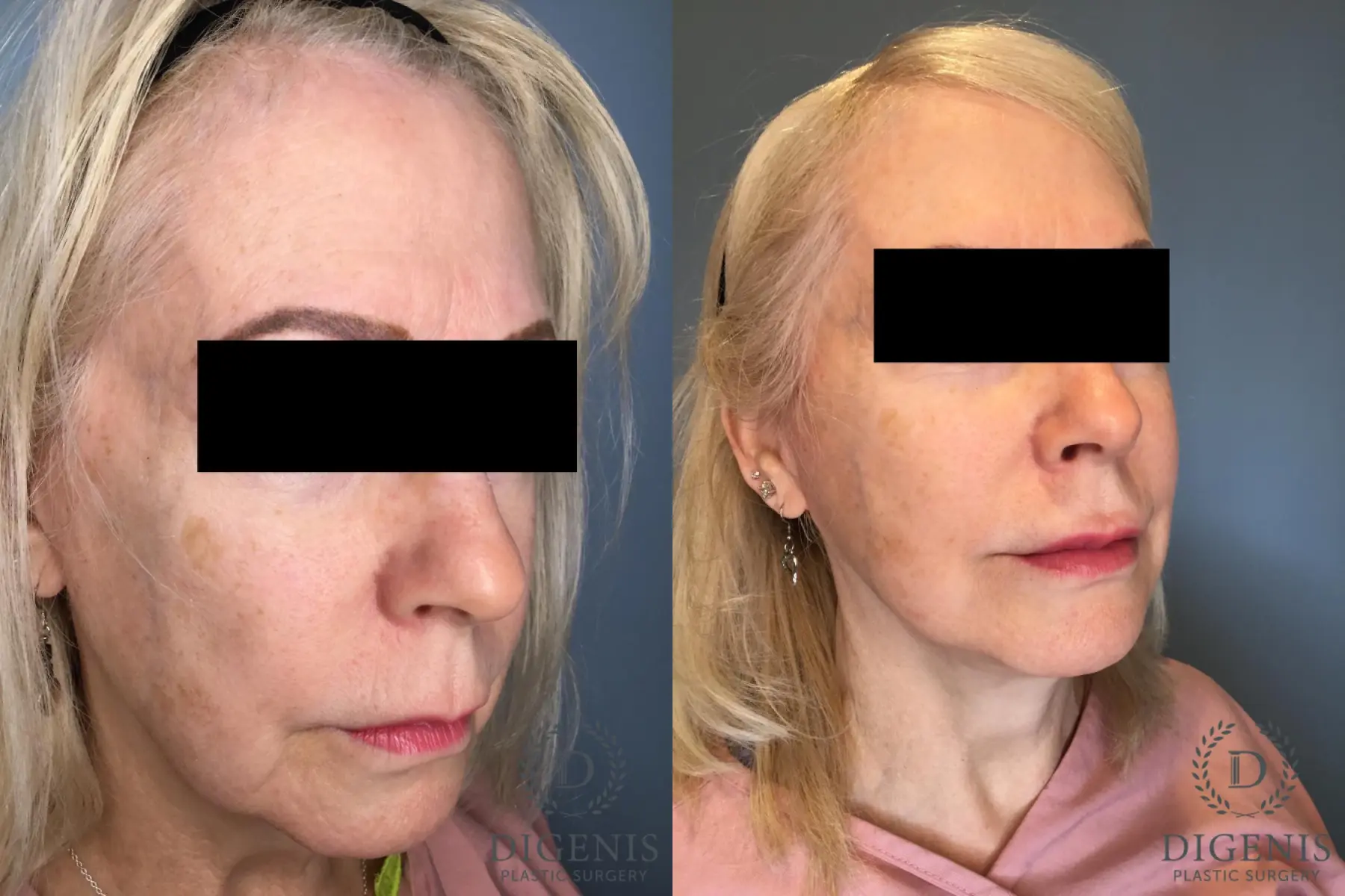Temple Lift: Patient 1 - Before and After 4