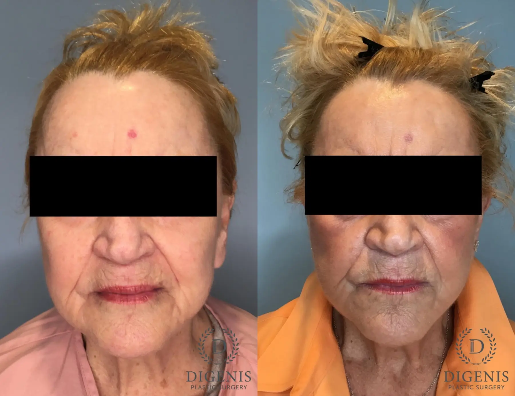 Temple Lift: Patient 2 - Before and After  