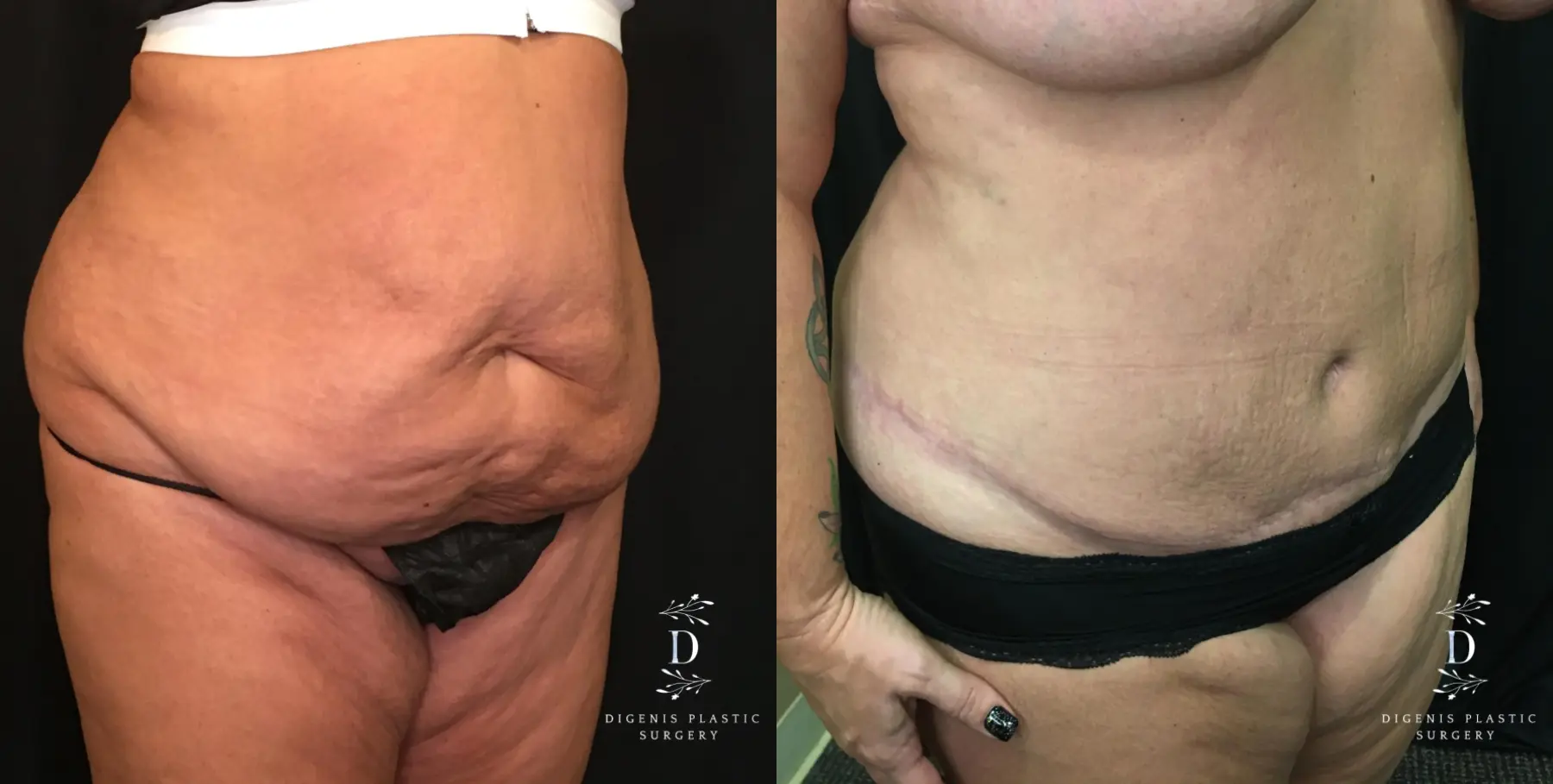 Tummy Tuck: Patient 14 - Before and After 2