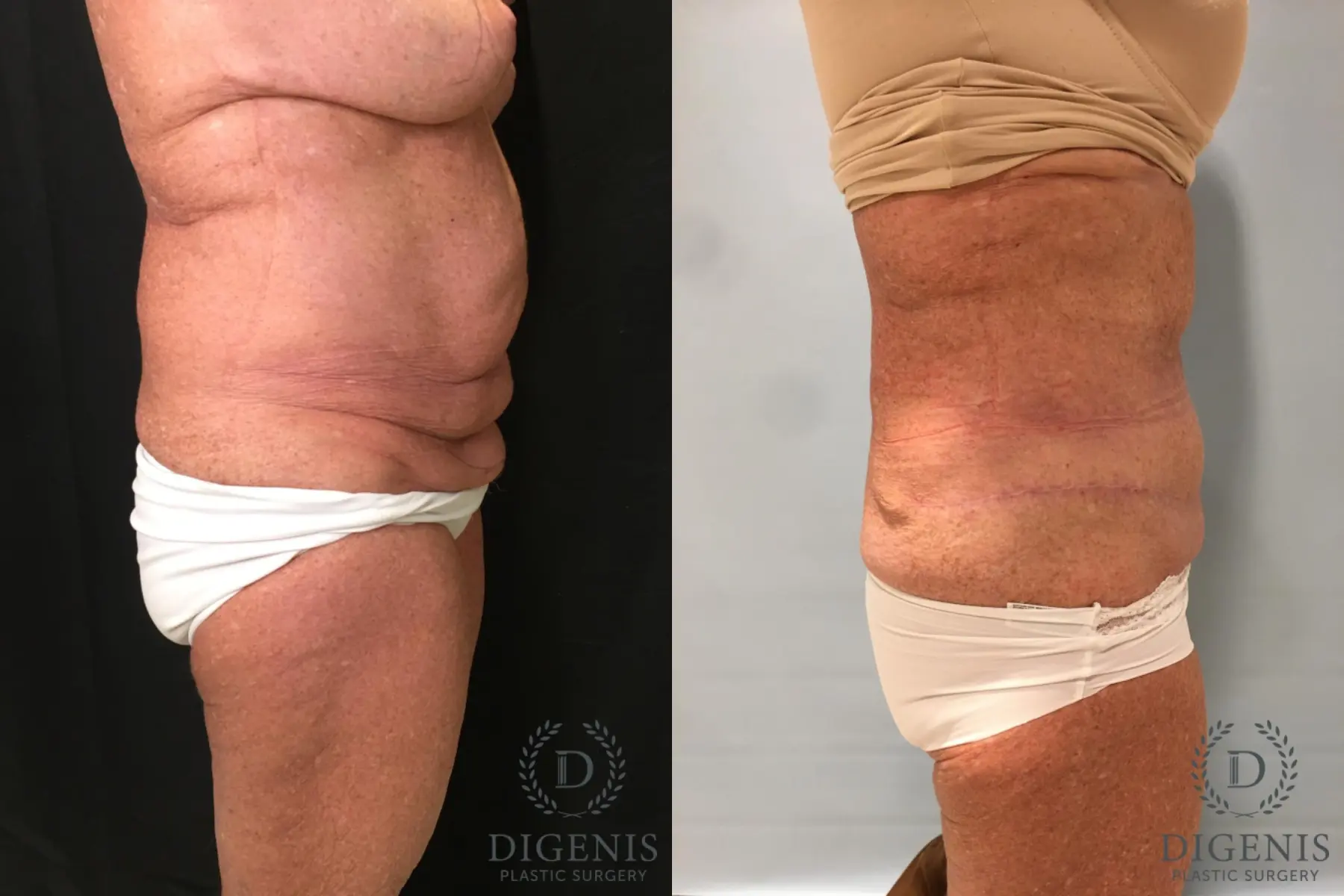 Tummy Tuck: Patient 27 - Before and After 5
