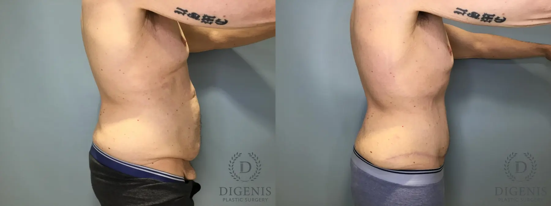 Tummy Tuck: Patient 5 - Before and After 3