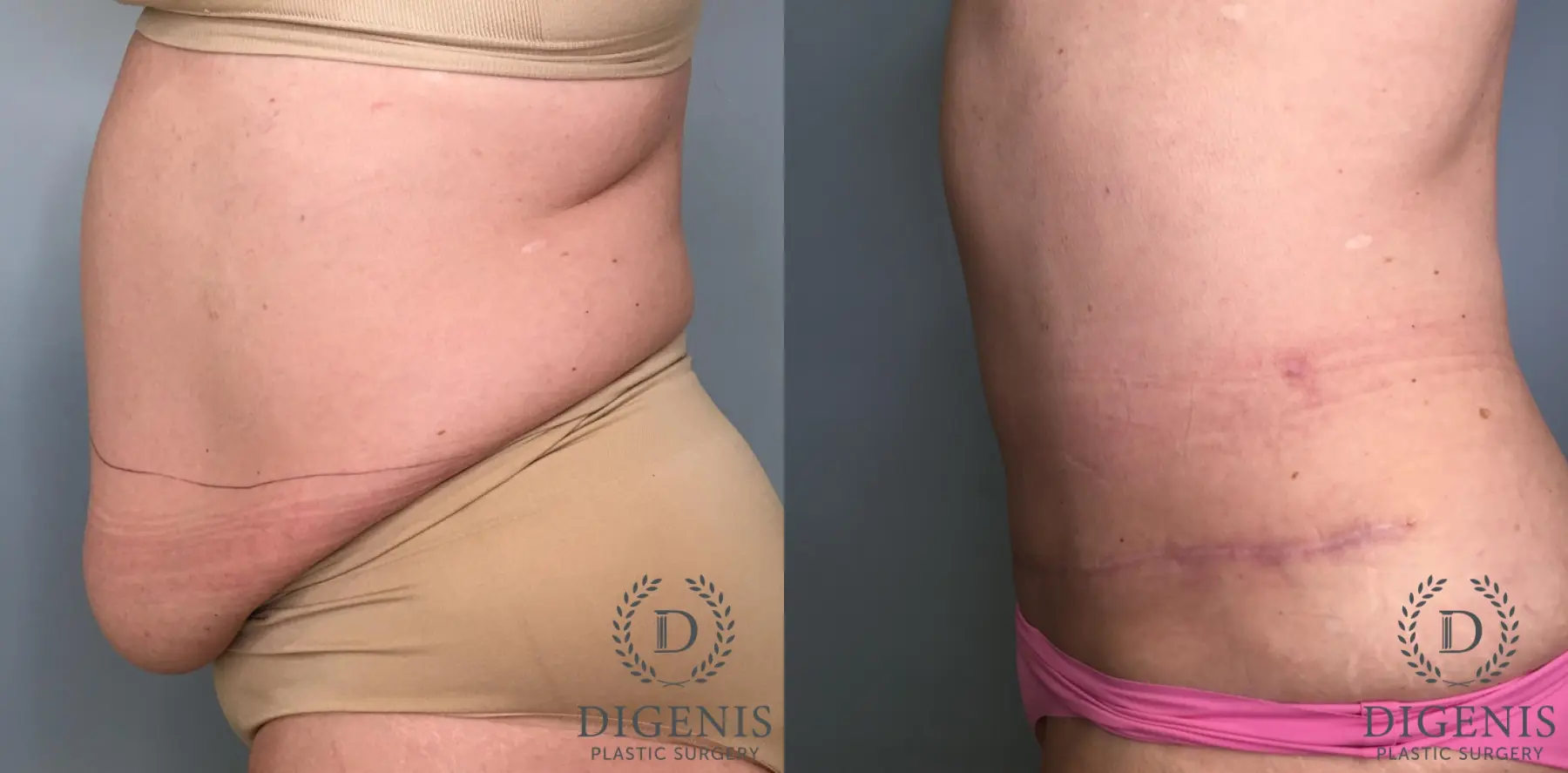 Tummy Tuck: Patient 29 - Before and After 3