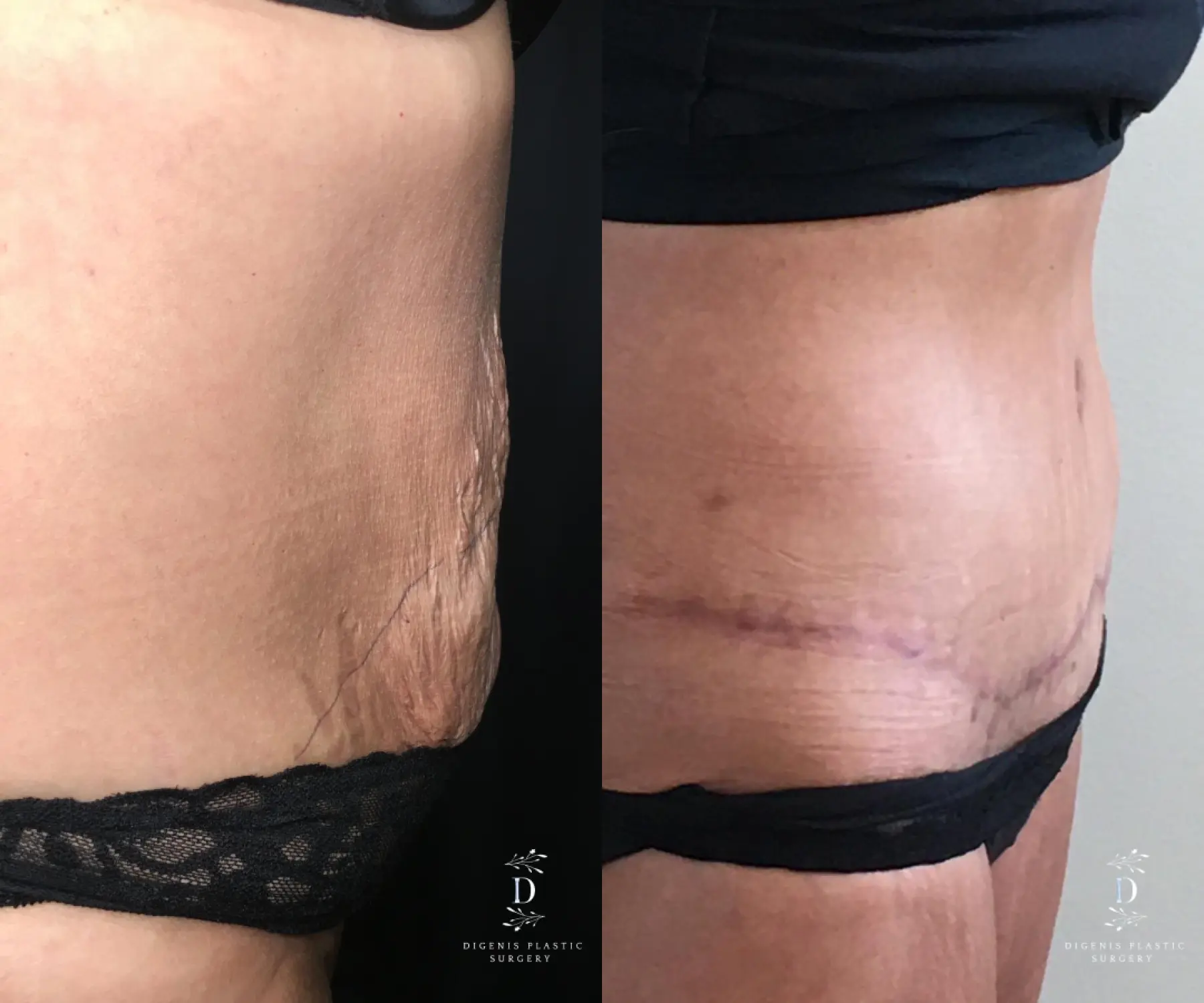Tummy Tuck: Patient 22 - Before and After 3
