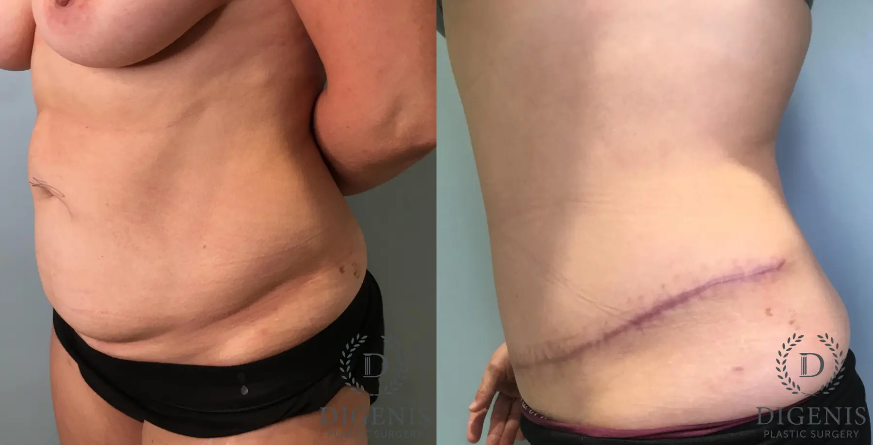 Tummy Tuck: Patient 31 - Before and After 4