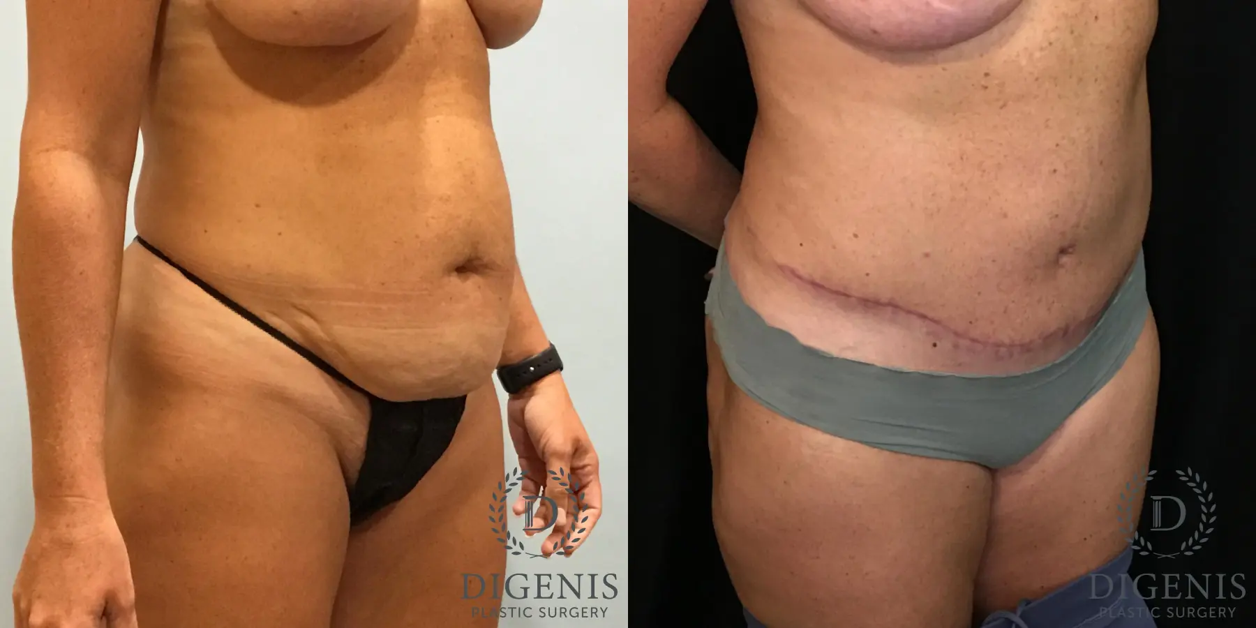 Tummy Tuck: Patient 9 - Before and After 2