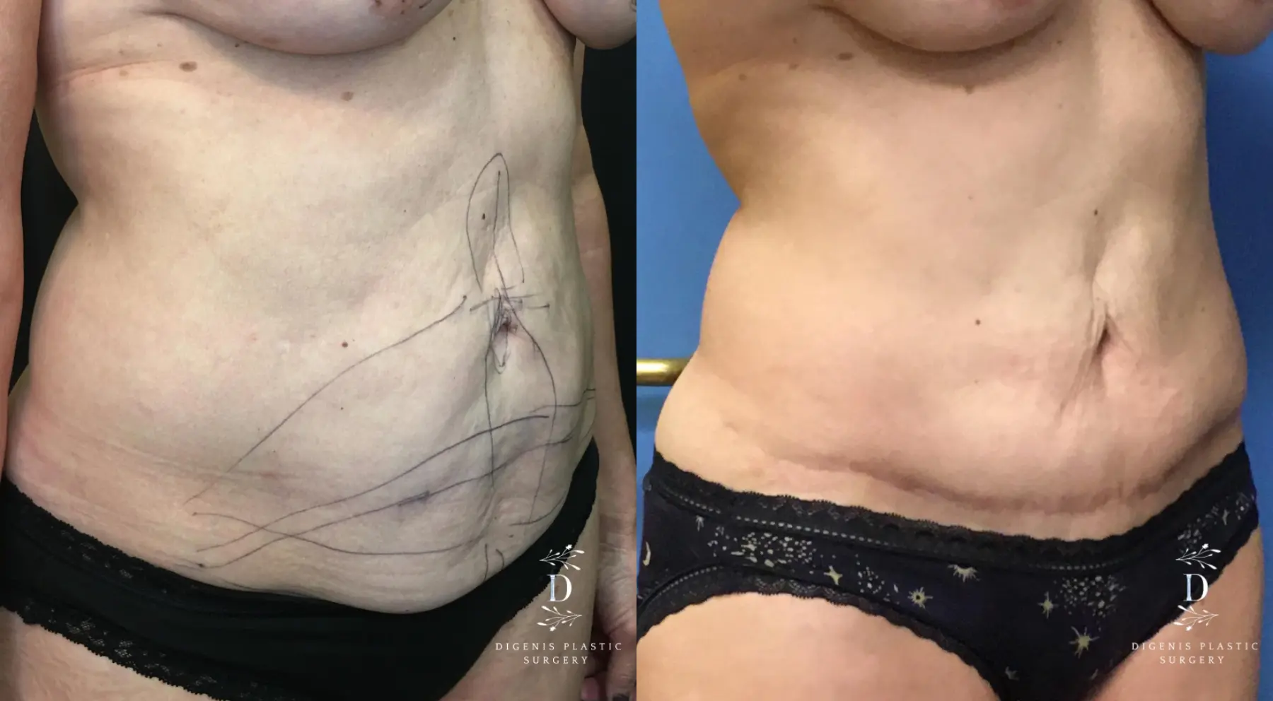 Tummy Tuck: Patient 20 - Before and After 2