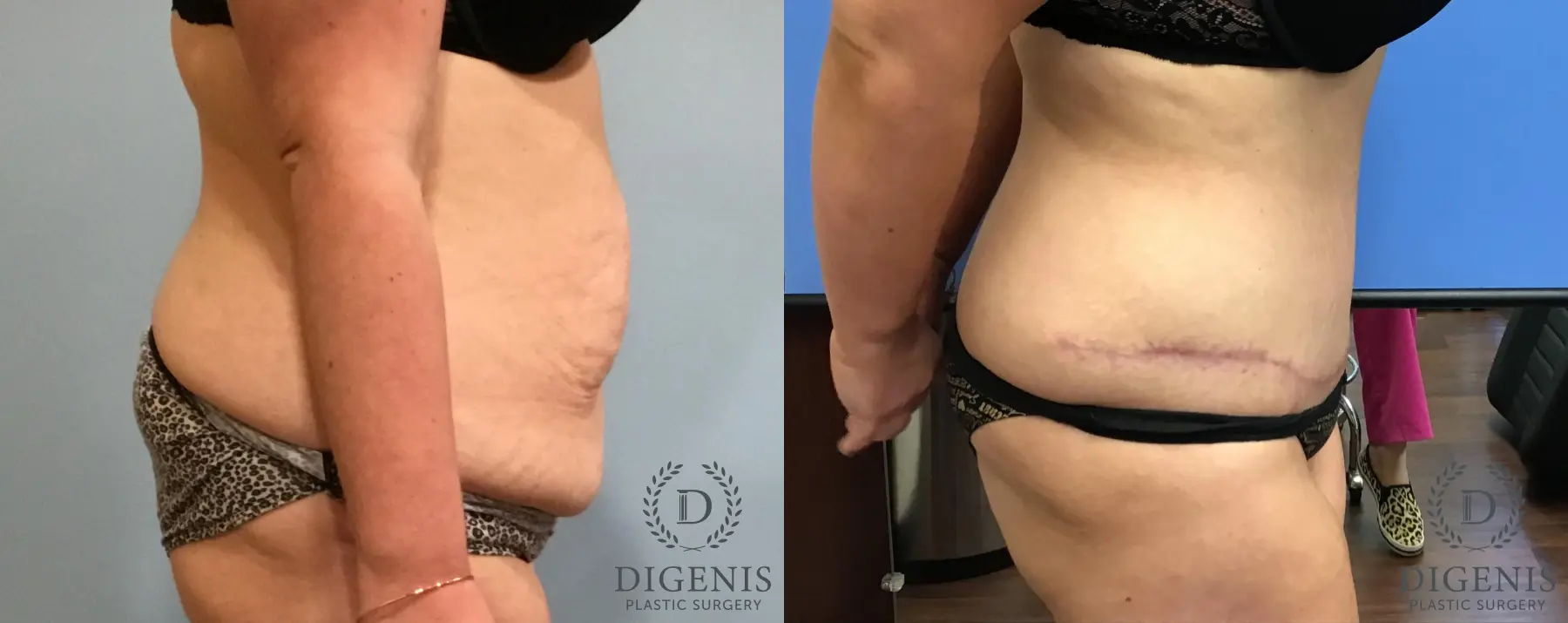 Tummy Tuck: Patient 11 - Before and After 3