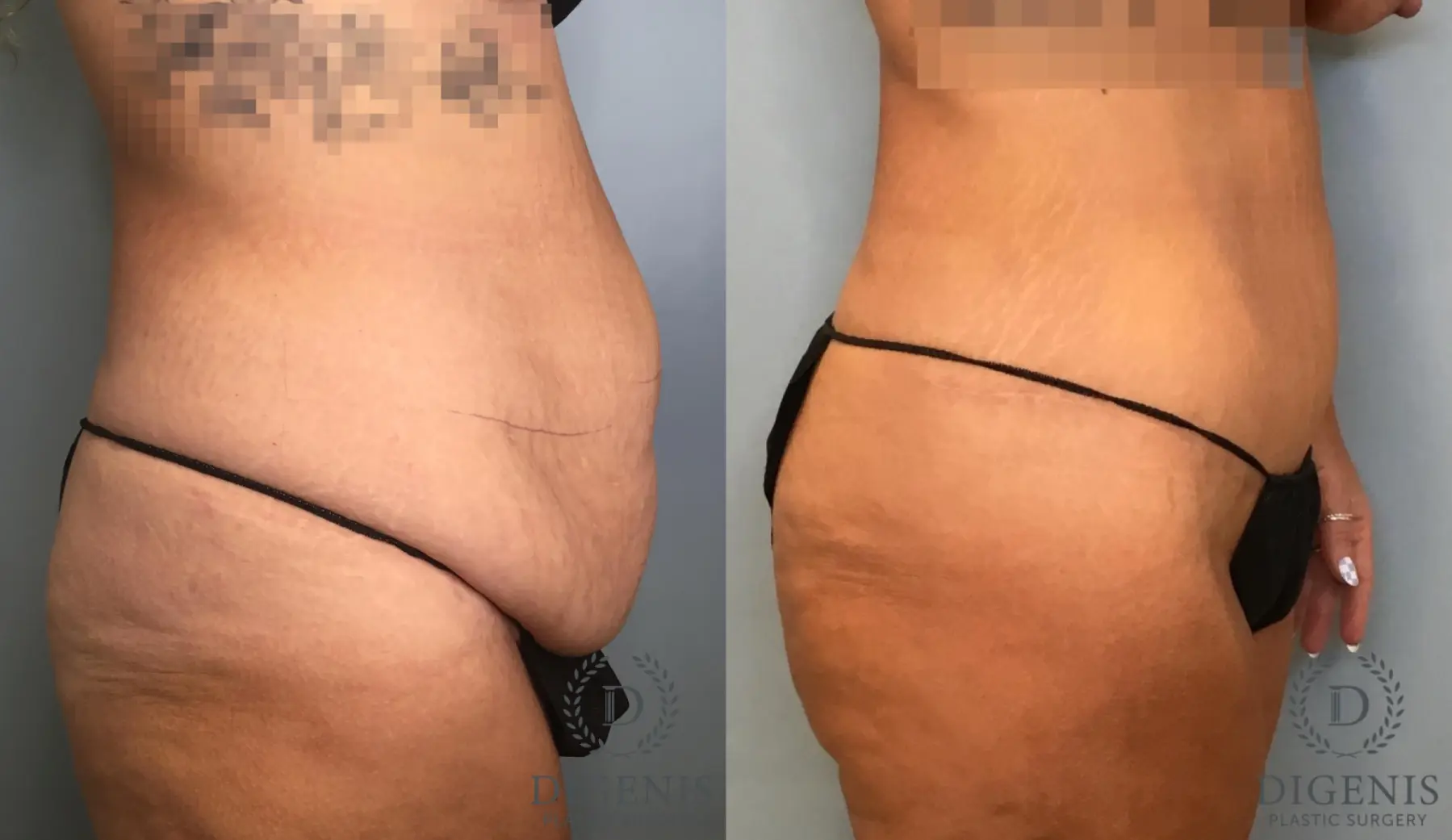 Tummy Tuck: Patient 23 - Before and After 5
