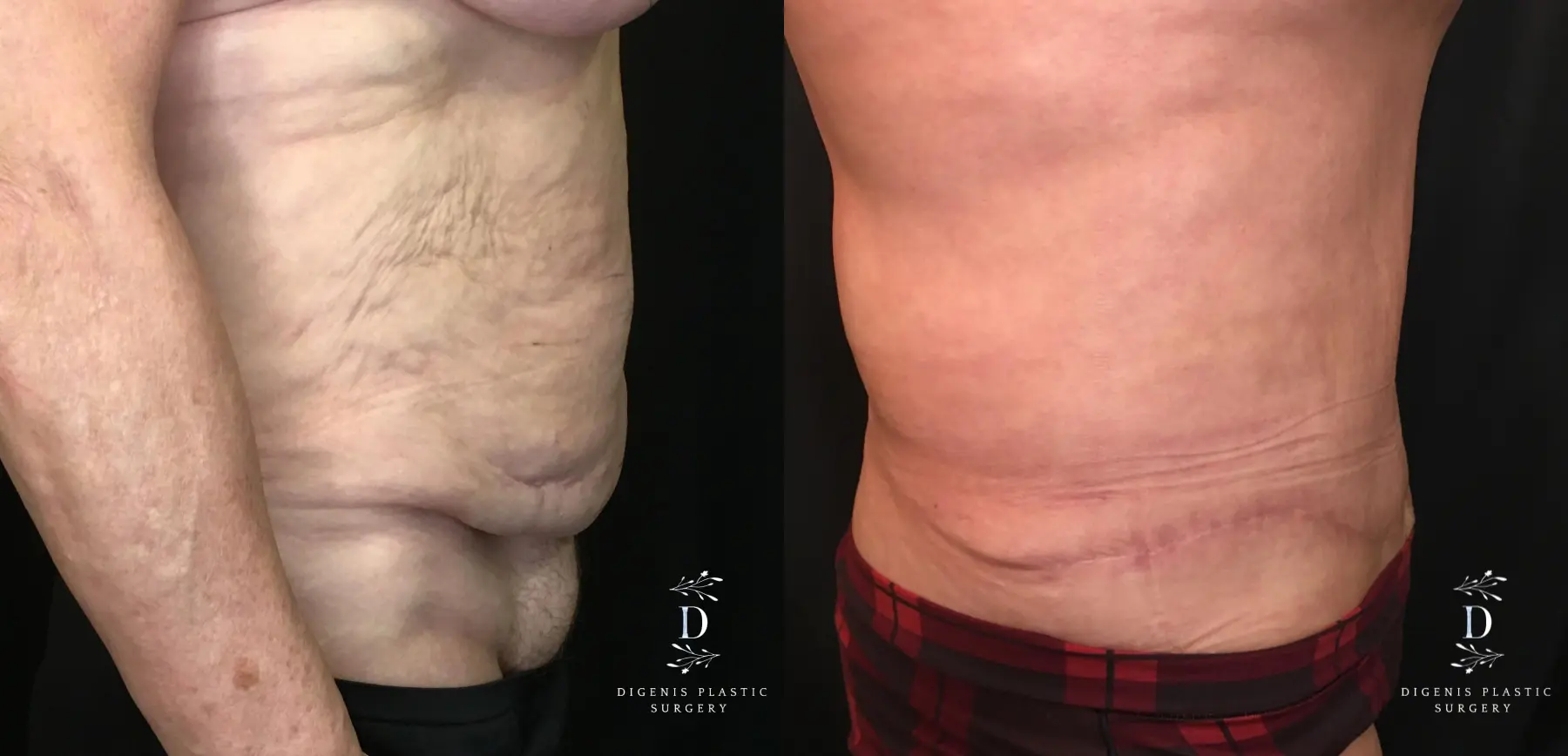 Tummy Tuck: Patient 16 - Before and After 3