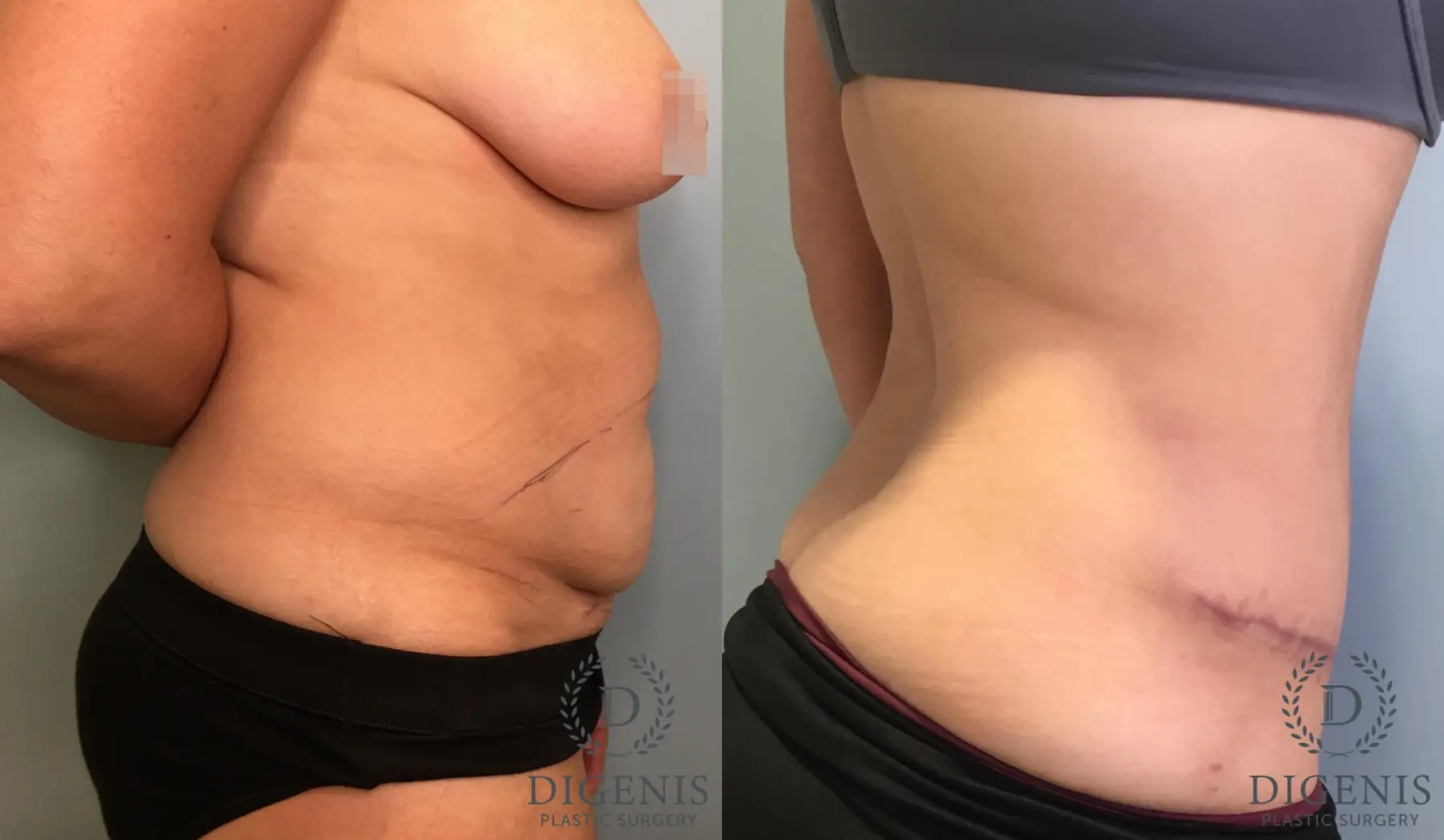Tummy Tuck: Patient 31 - Before and After 3