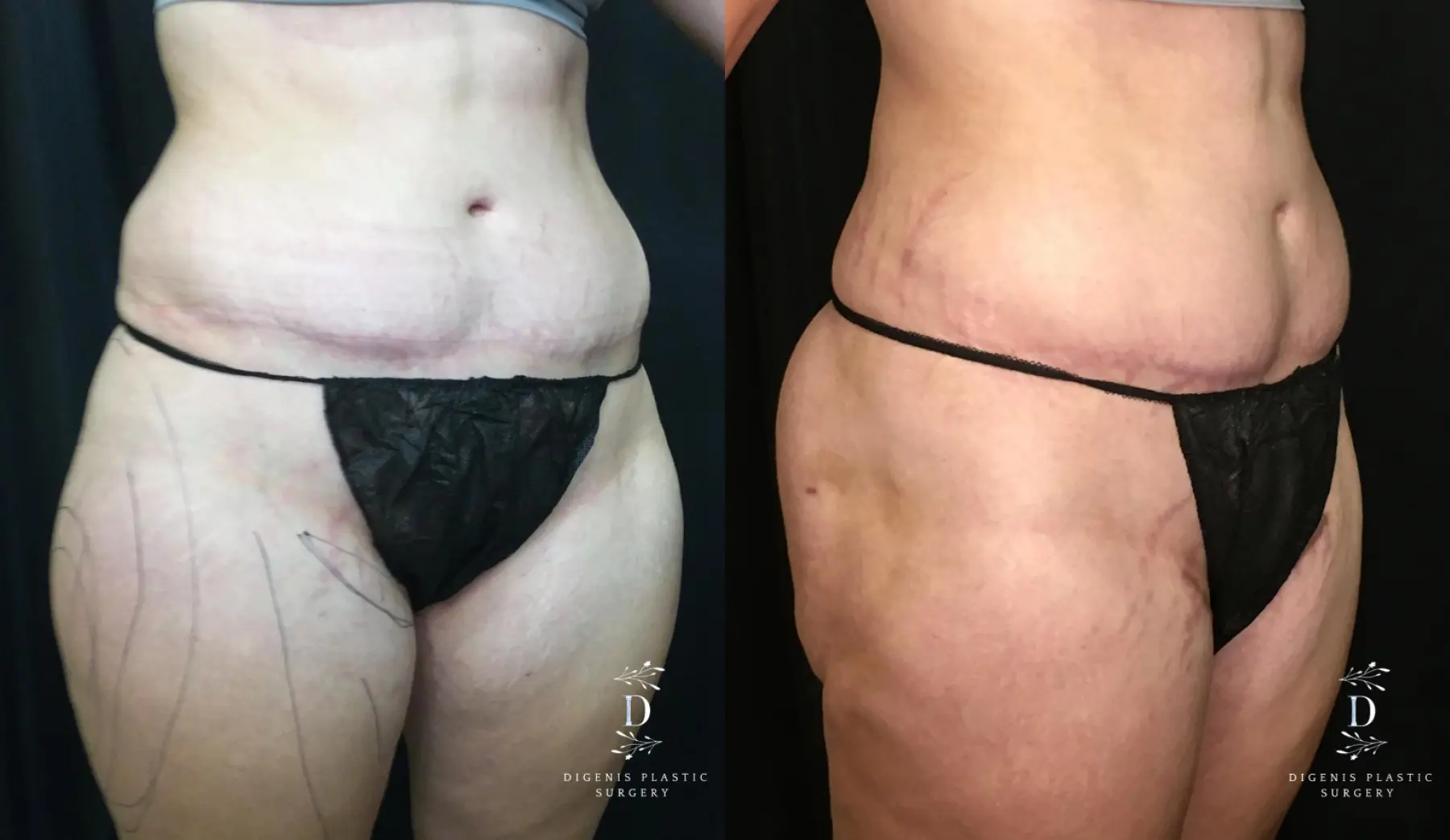 Tummy Tuck: Patient 21 - Before and After 2