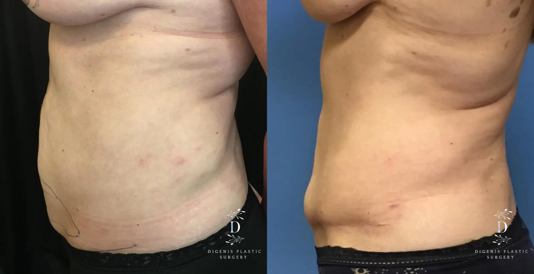 Tummy Tuck: Patient 20 - Before and After 5