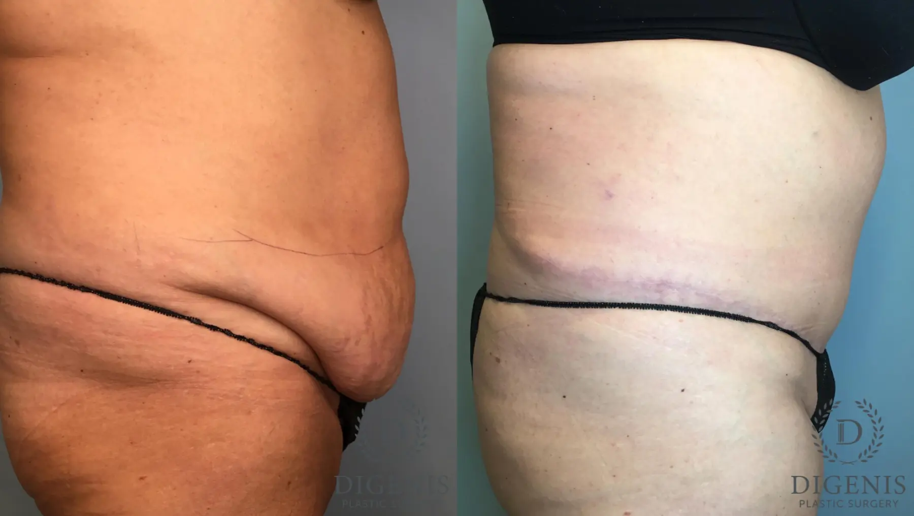 Tummy Tuck: Patient 1 - Before and After 5