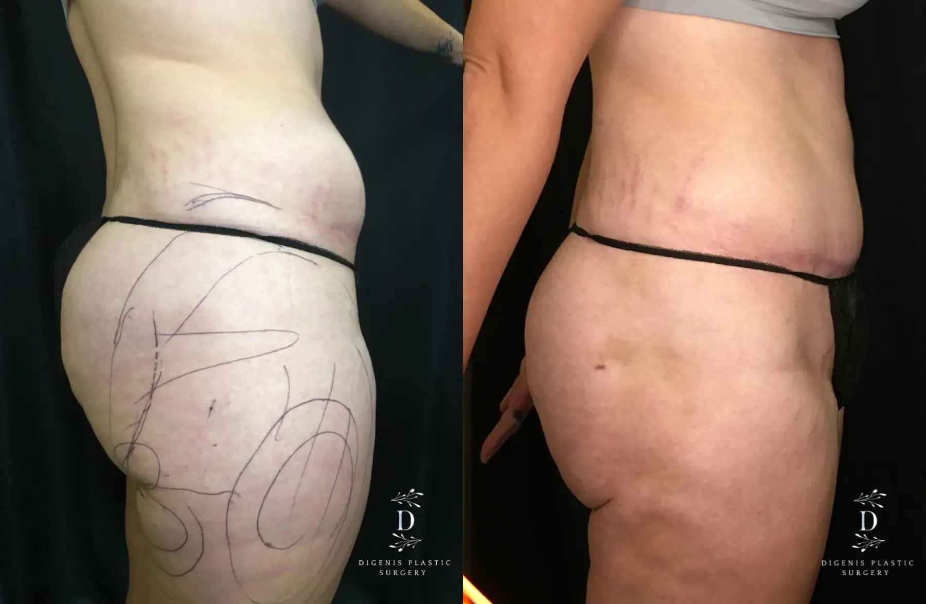 Tummy Tuck: Patient 21 - Before and After 3