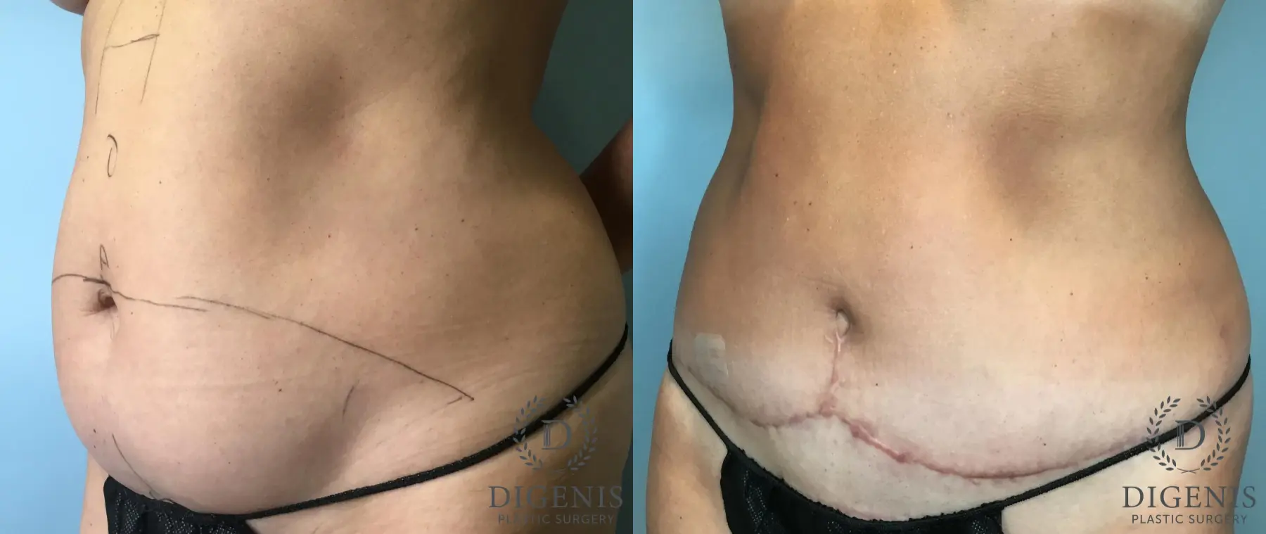Tummy Tuck: Patient 2 - Before and After 3