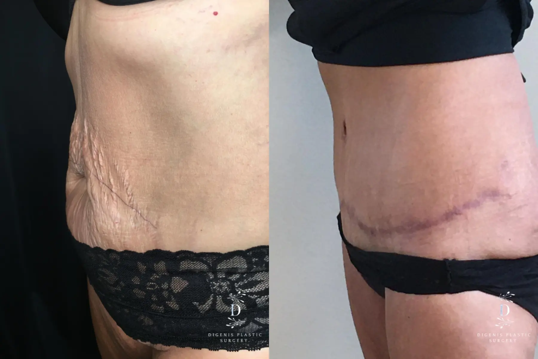 Tummy Tuck: Patient 22 - Before and After 4