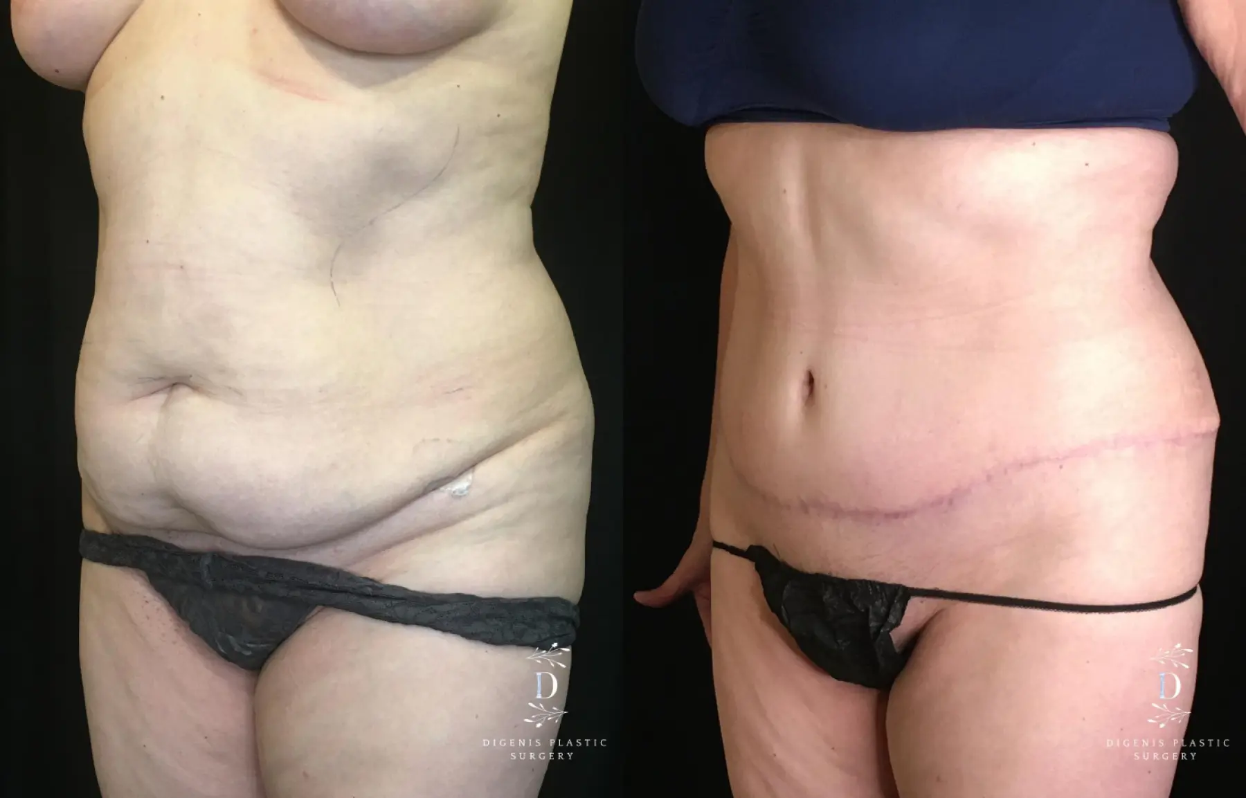 Tummy Tuck: Patient 19 - Before and After 4