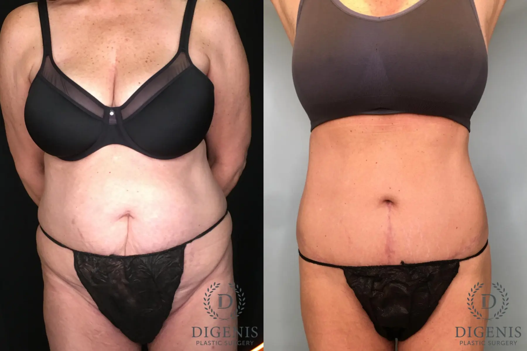 Tummy Tuck: Patient 28 - Before and After  