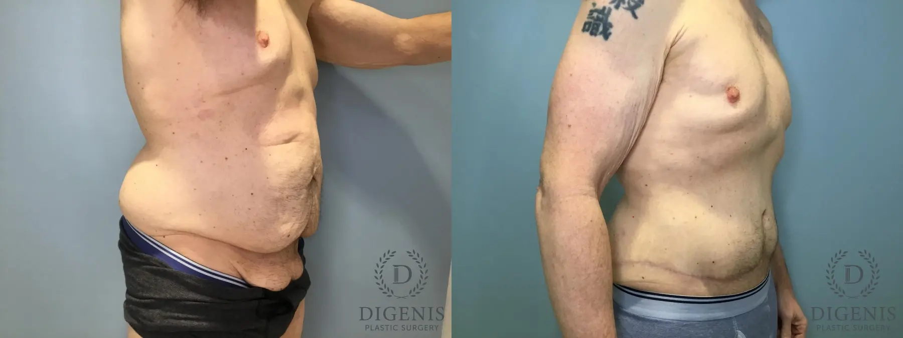 Tummy Tuck: Patient 5 - Before and After 2