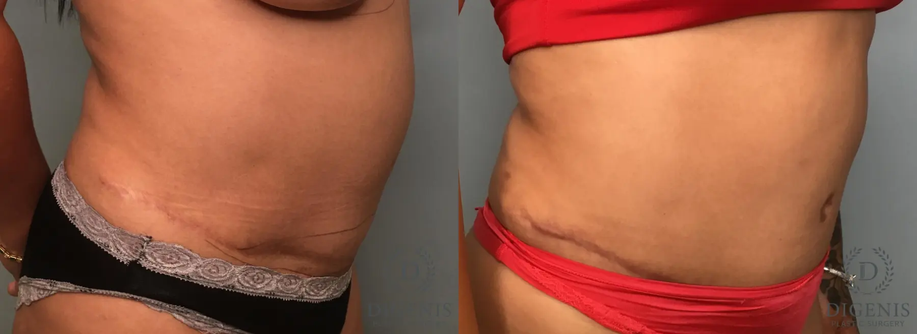 Tummy Tuck: Patient 35 - Before and After 2