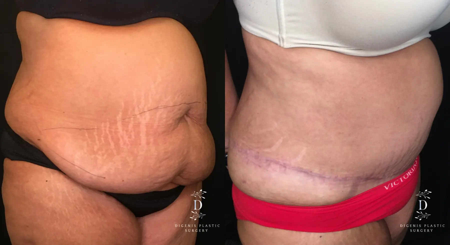 Tummy Tuck: Patient 18 - Before and After 2