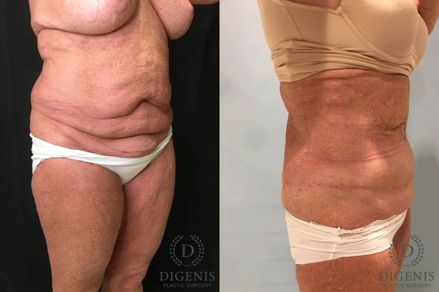 Tummy Tuck: Patient 27 - Before and After 4