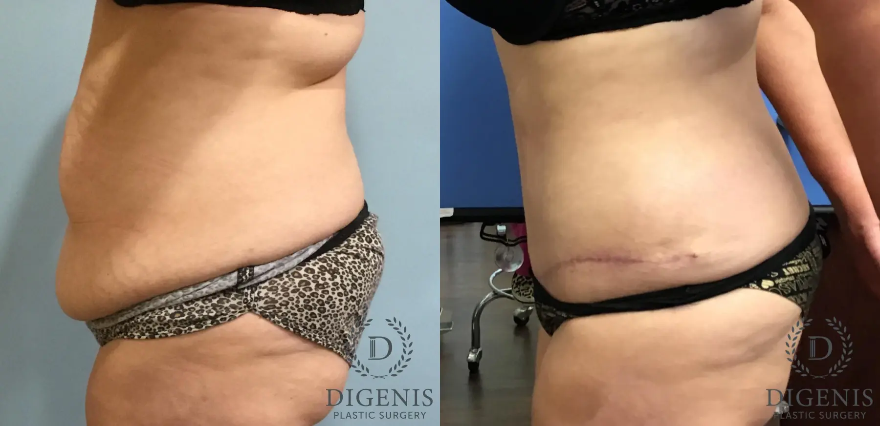 Tummy Tuck: Patient 11 - Before and After 5