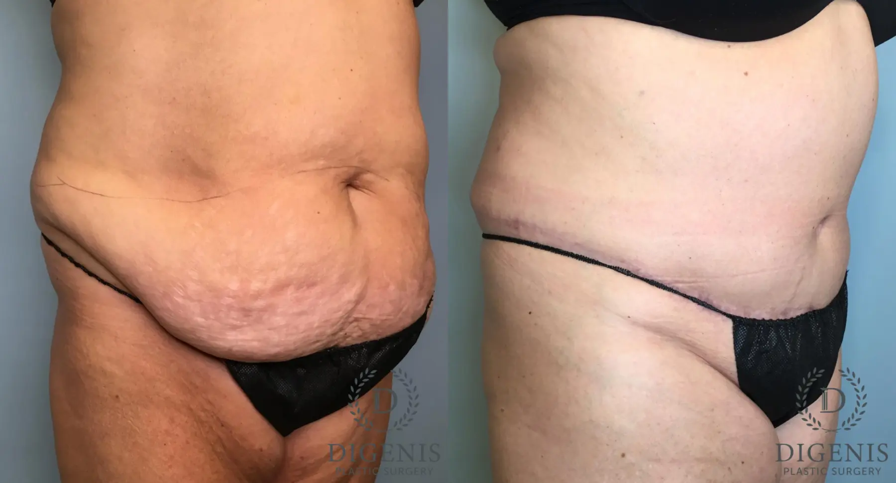 Tummy Tuck: Patient 1 - Before and After 4