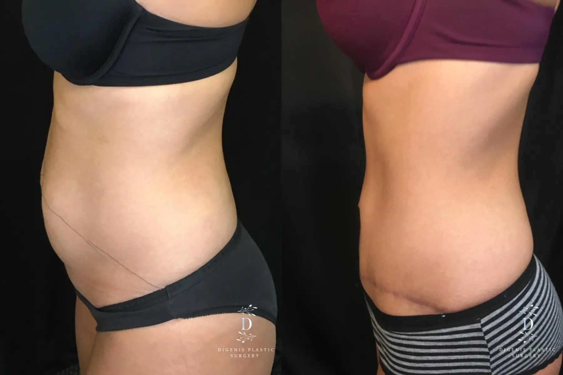 Tummy Tuck: Patient 15 - Before and After 5