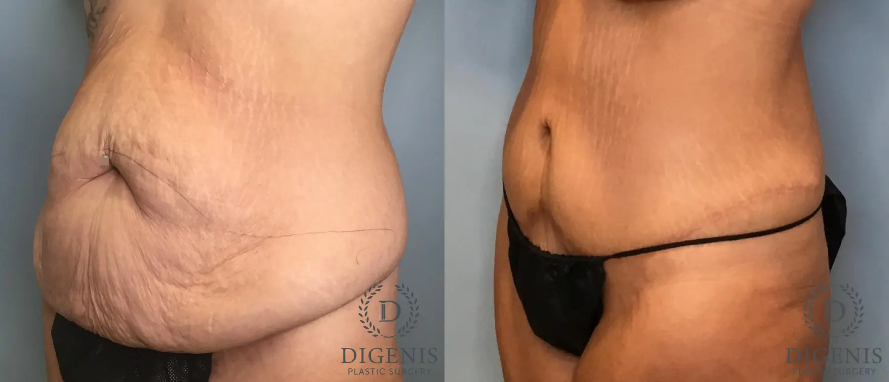 Tummy Tuck: Patient 23 - Before and After 2