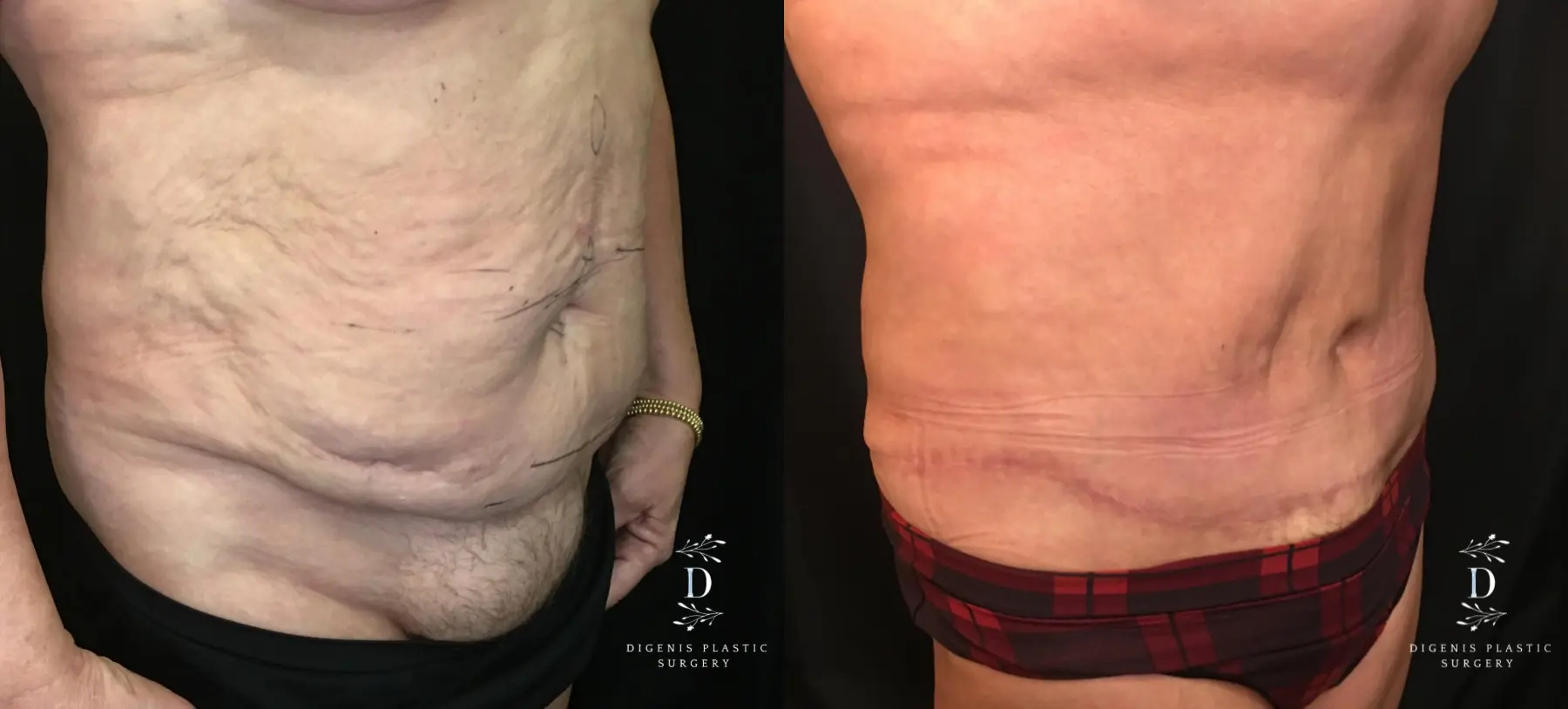 Tummy Tuck: Patient 16 - Before and After 2