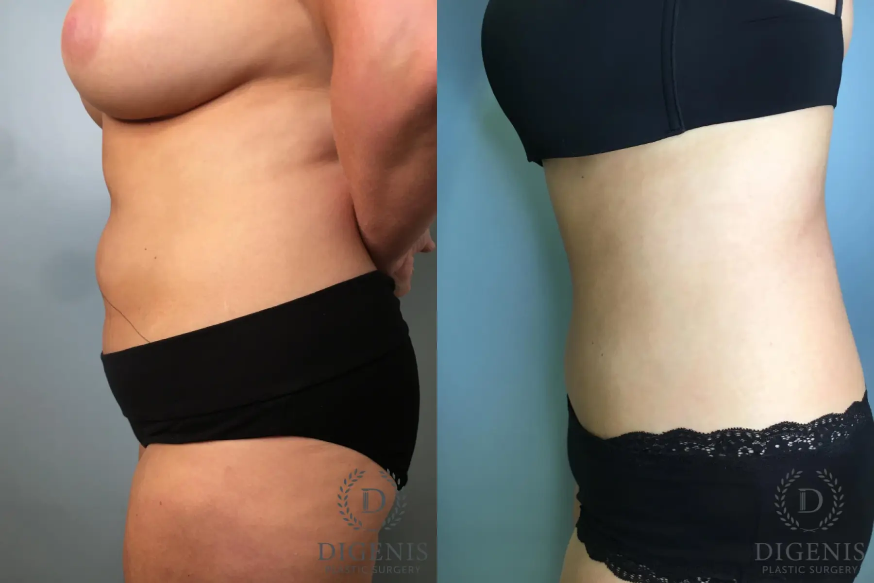Tummy Tuck: Patient 33 - Before and After 5