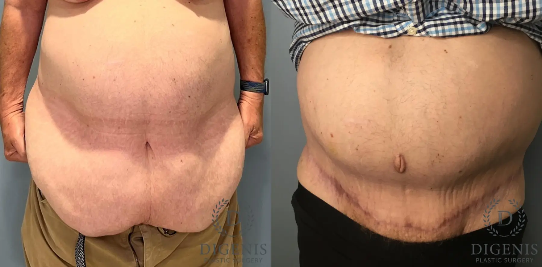 Tummy Tuck: Patient 4 - Before and After  