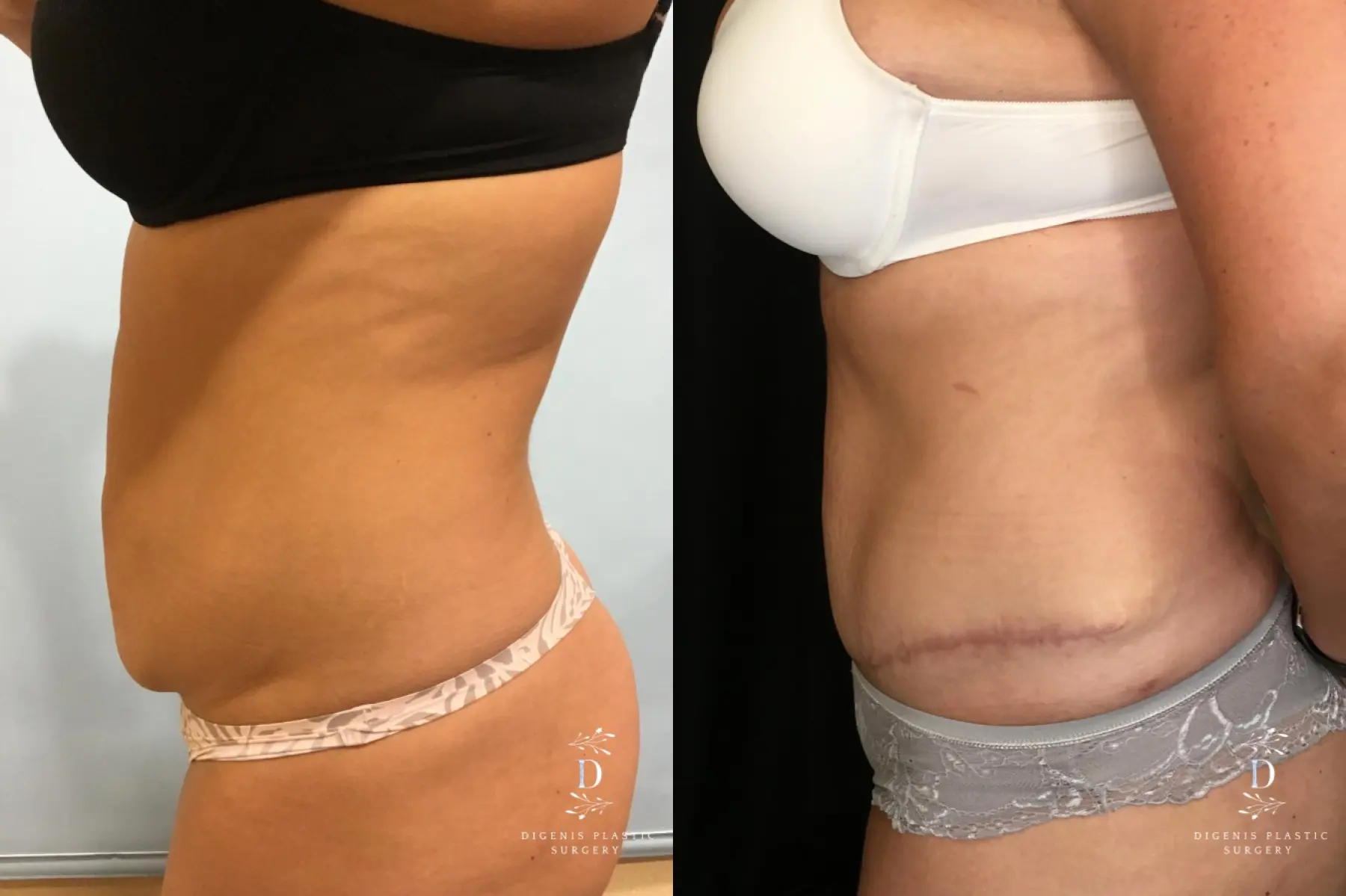 Tummy Tuck: Patient 12 - Before and After 3