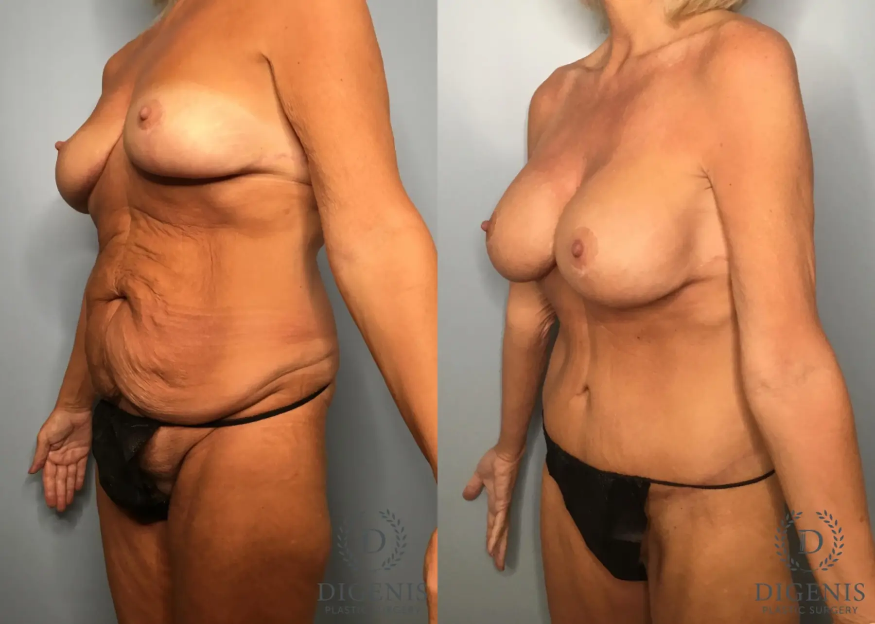 Tummy Tuck: Patient 32 - Before and After 4