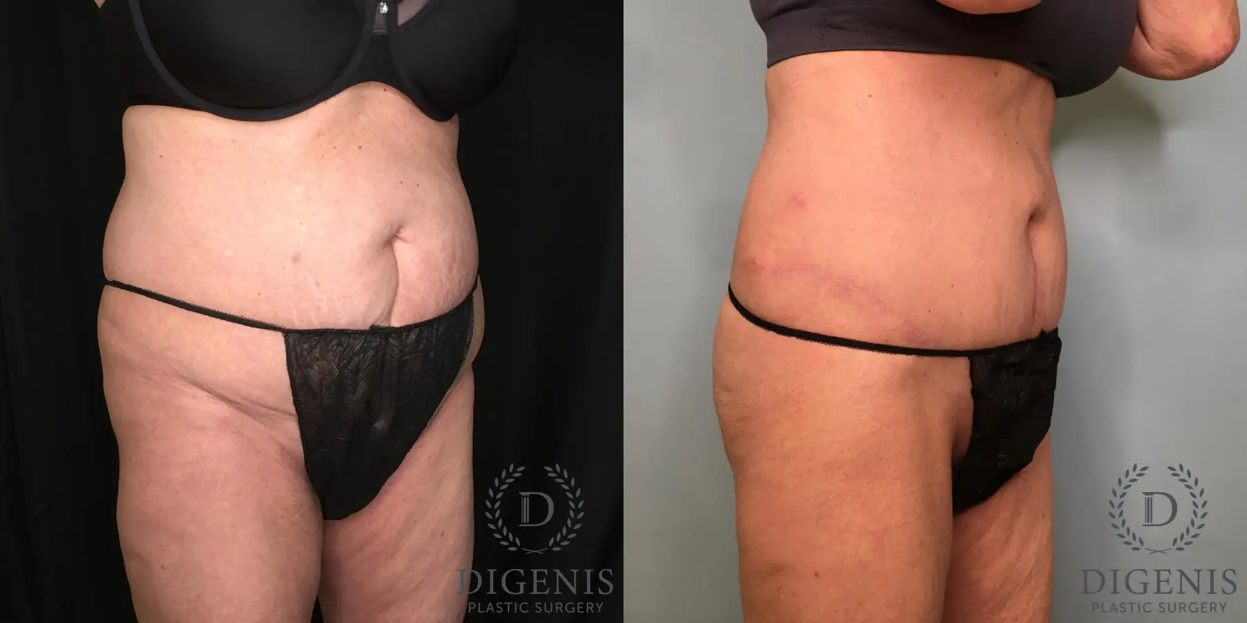 Tummy Tuck: Patient 28 - Before and After 4