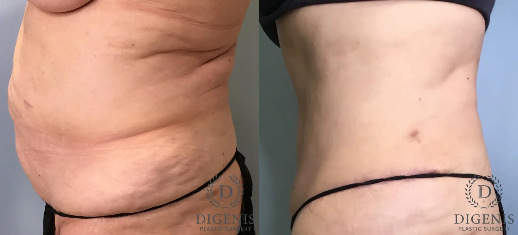 Tummy Tuck: Patient 34 - Before and After 5