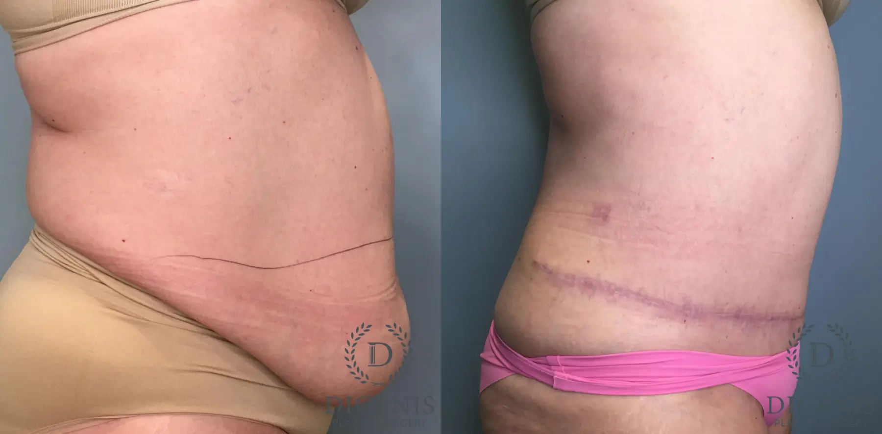 Tummy Tuck: Patient 29 - Before and After 2