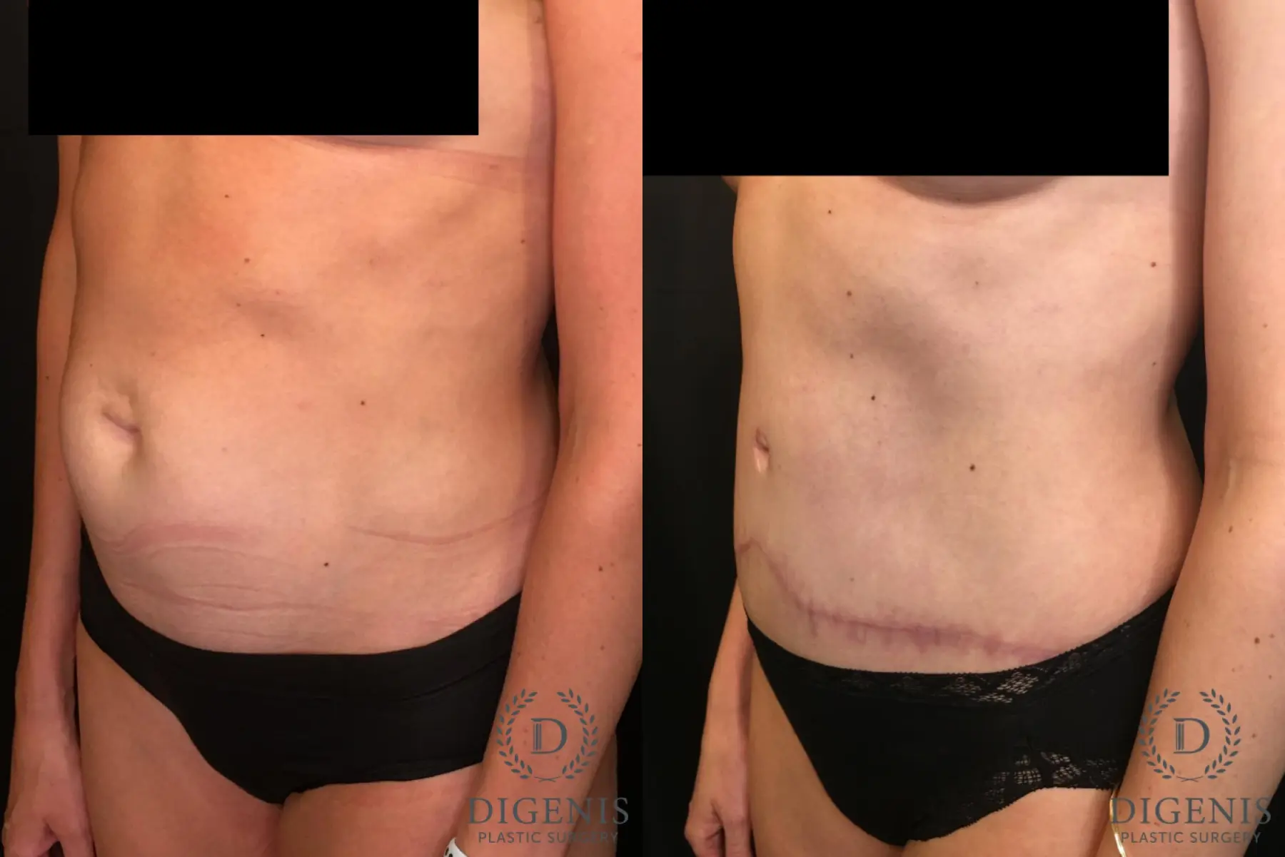 Tummy Tuck: Patient 3 - Before and After 4