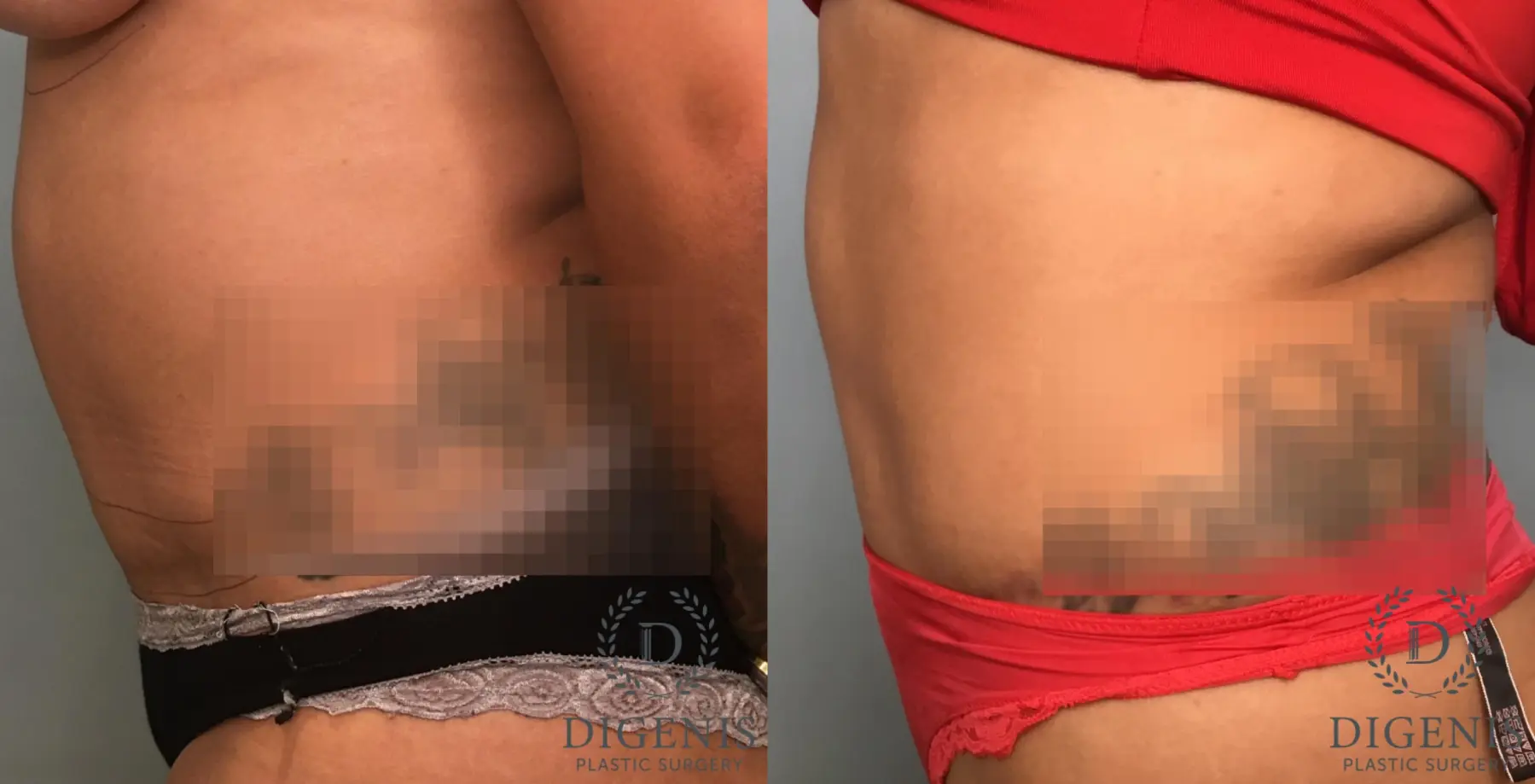 Tummy Tuck: Patient 35 - Before and After 5