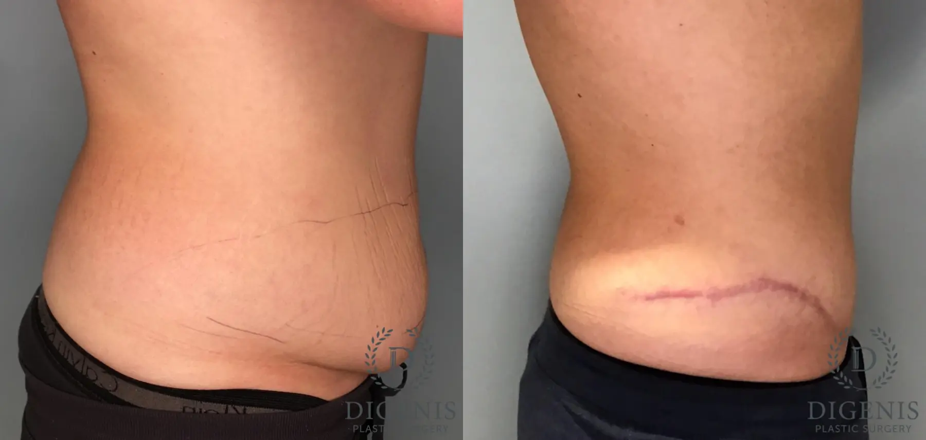 Tummy Tuck: Patient 36 - Before and After 3