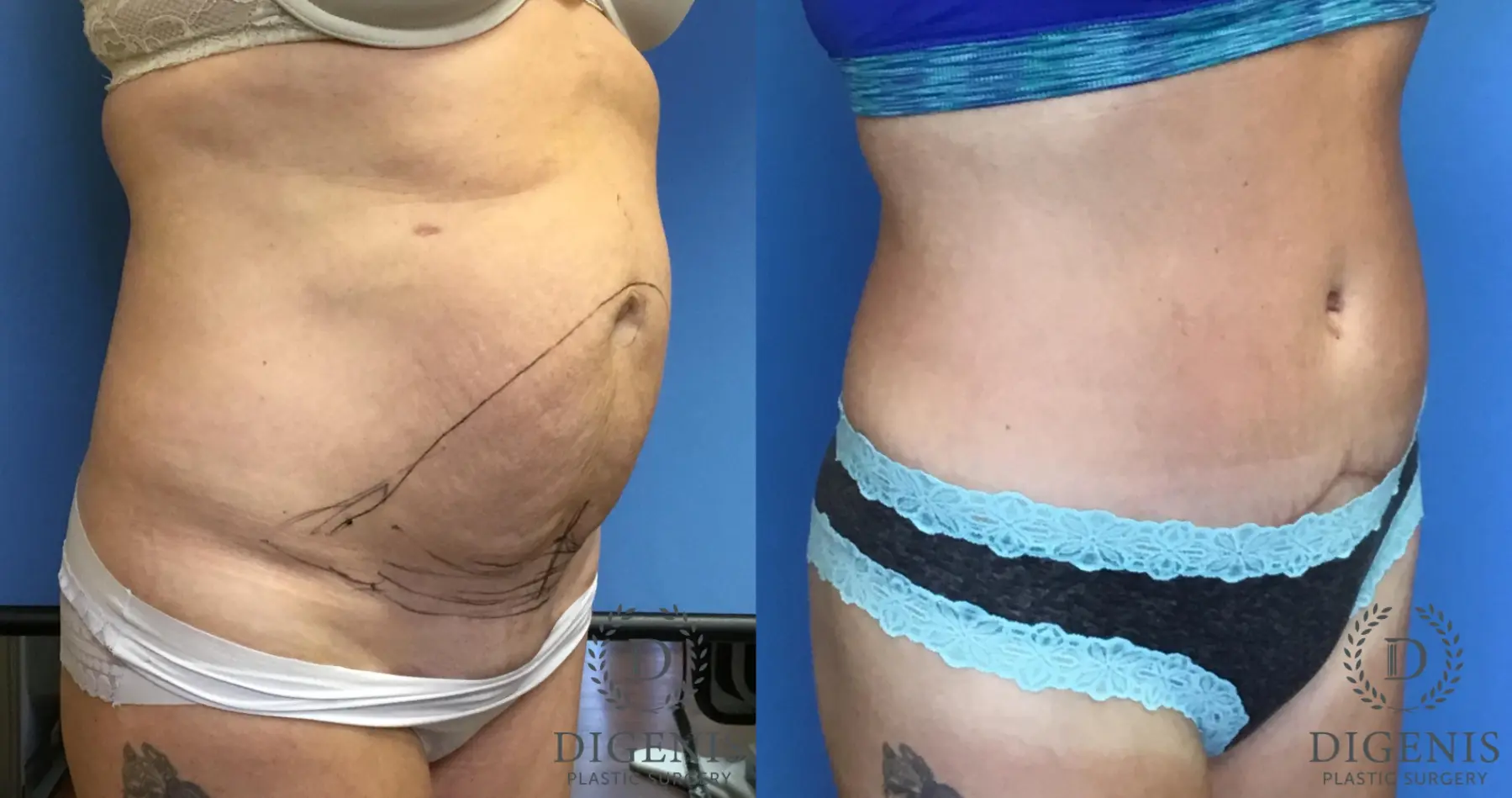 Tummy Tuck: Patient 8 - Before and After 2