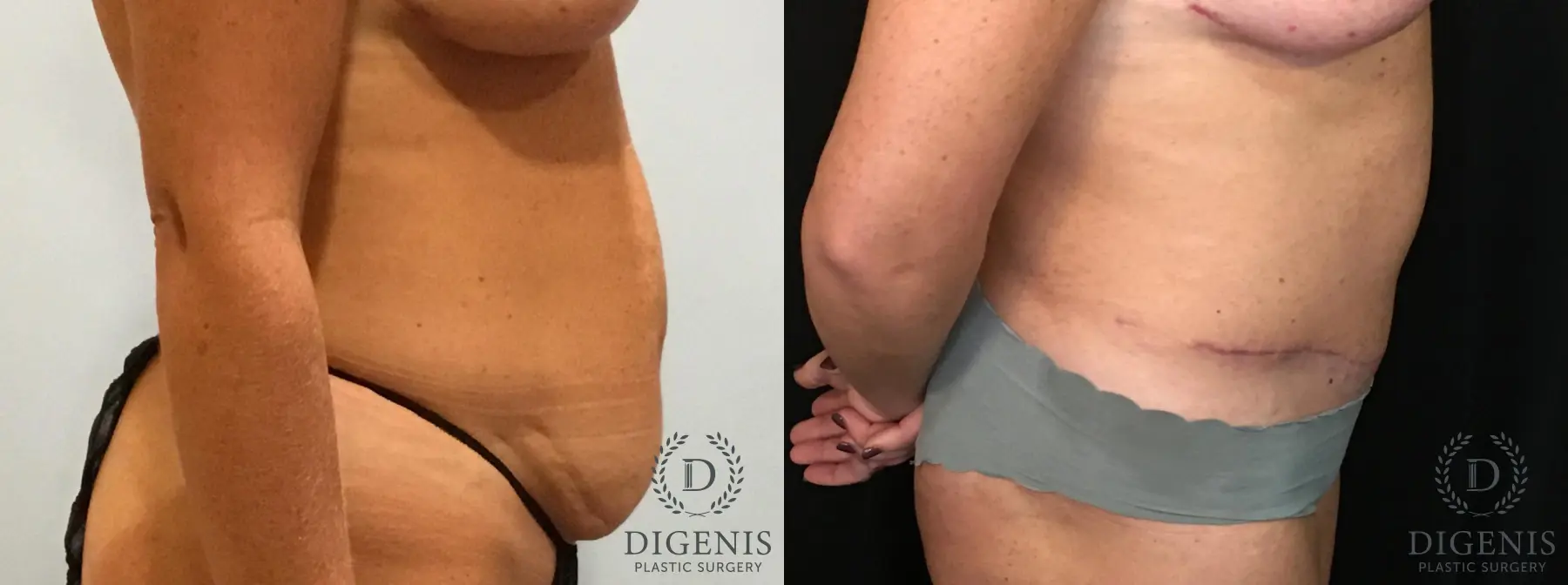 Tummy Tuck: Patient 9 - Before and After 3