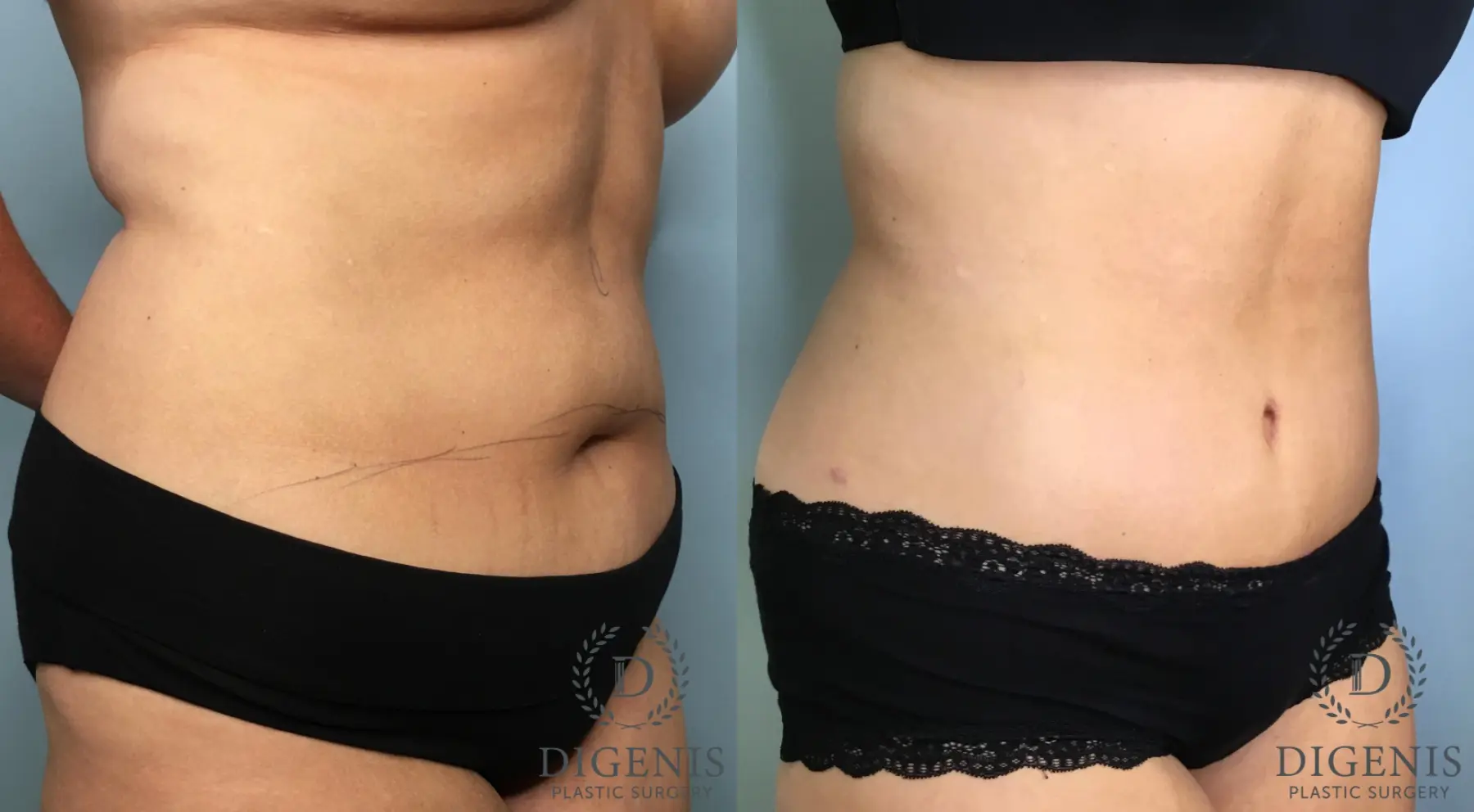 Tummy Tuck: Patient 33 - Before and After 2