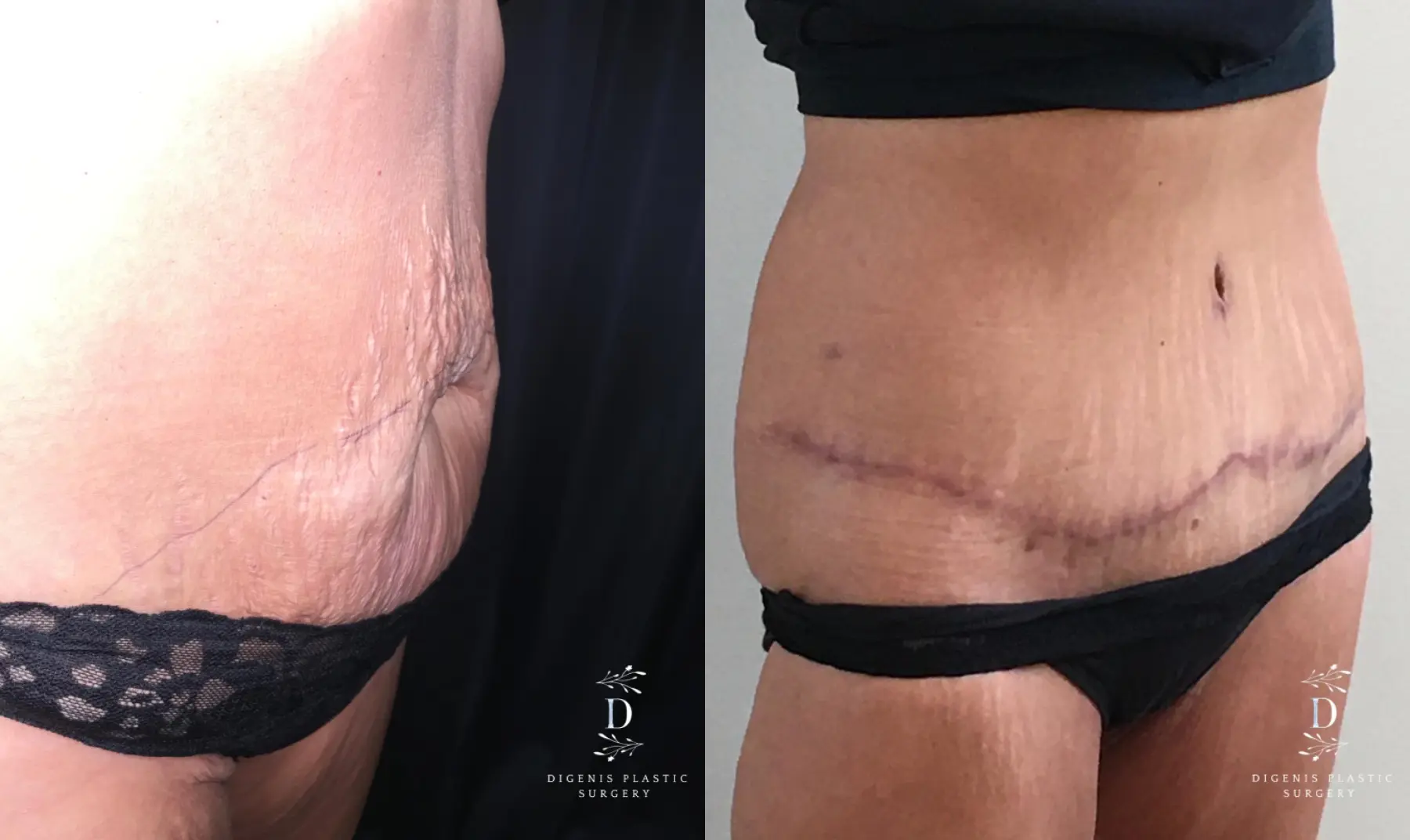 Tummy Tuck: Patient 22 - Before and After 2