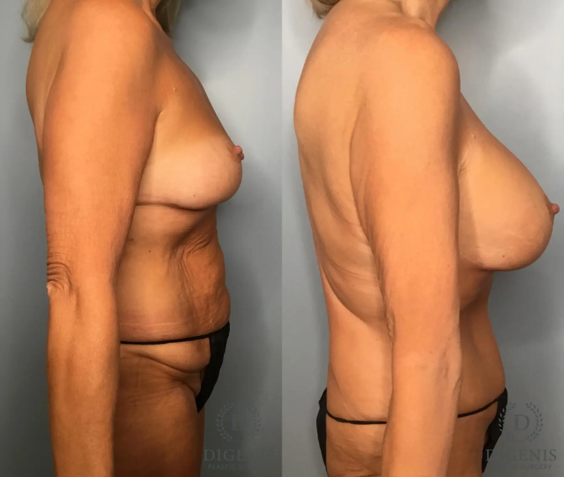 Tummy Tuck: Patient 32 - Before and After 3