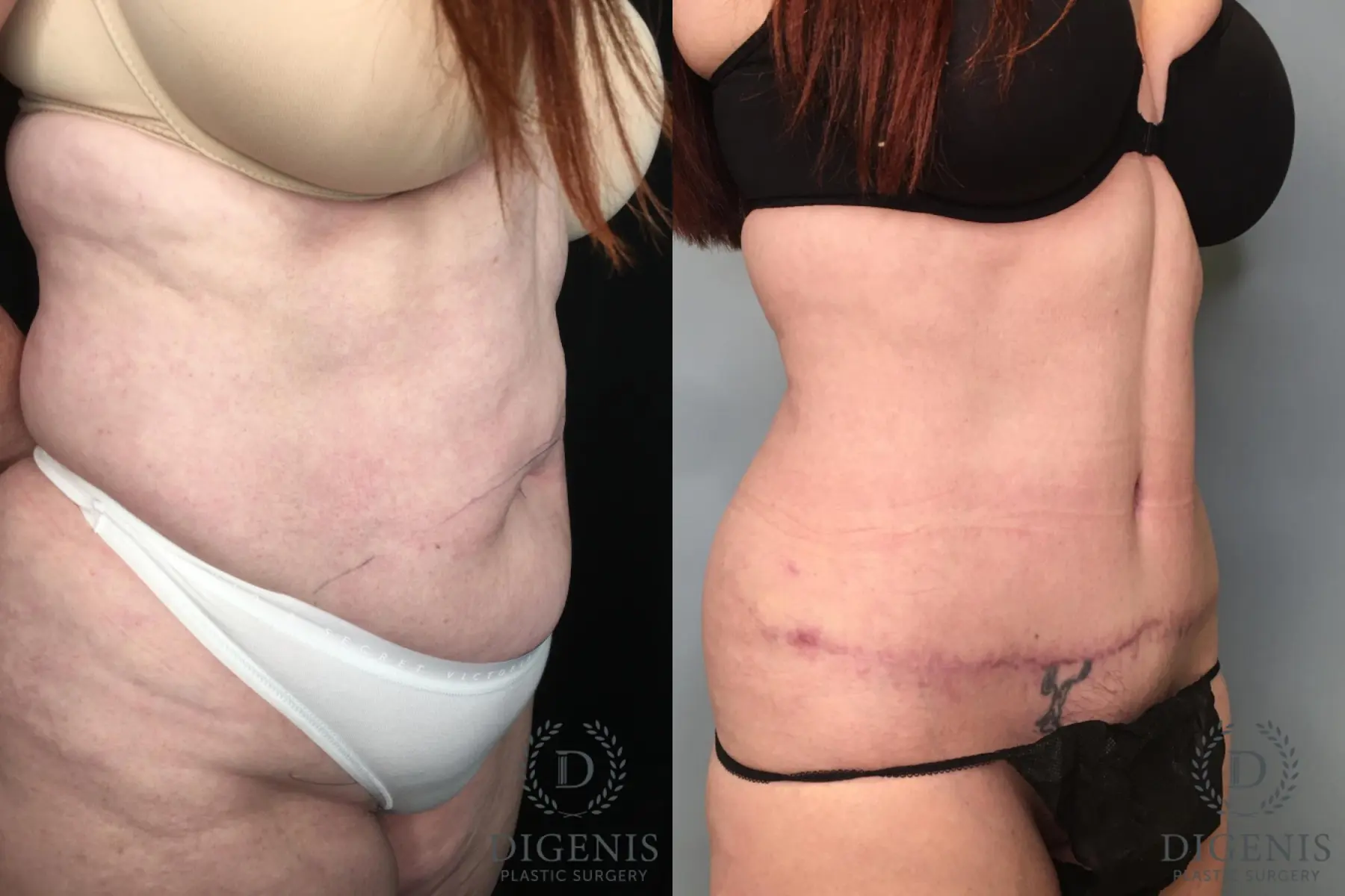 Tummy Tuck: Patient 25 - Before and After 5