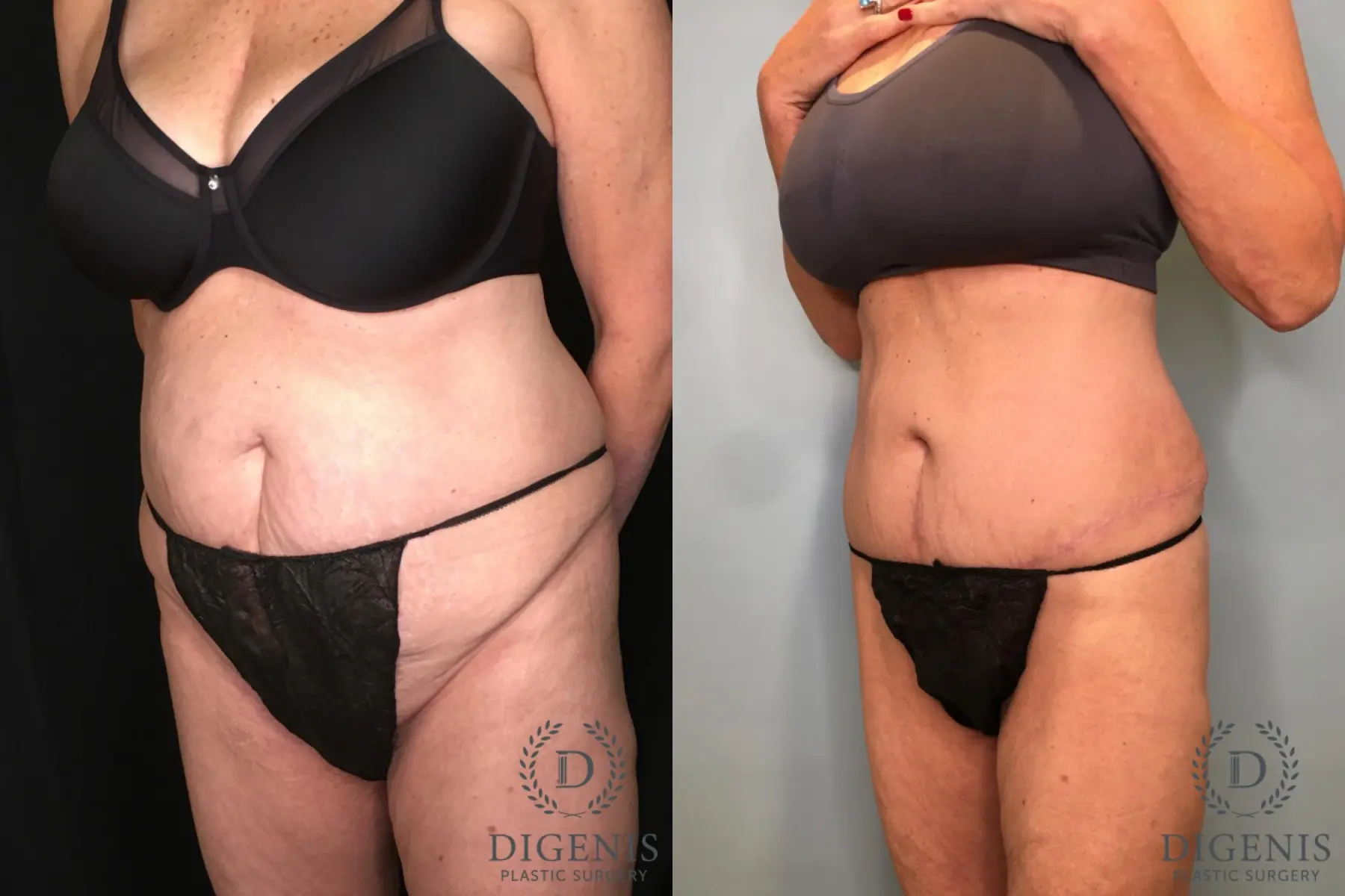 Tummy Tuck: Patient 28 - Before and After 2