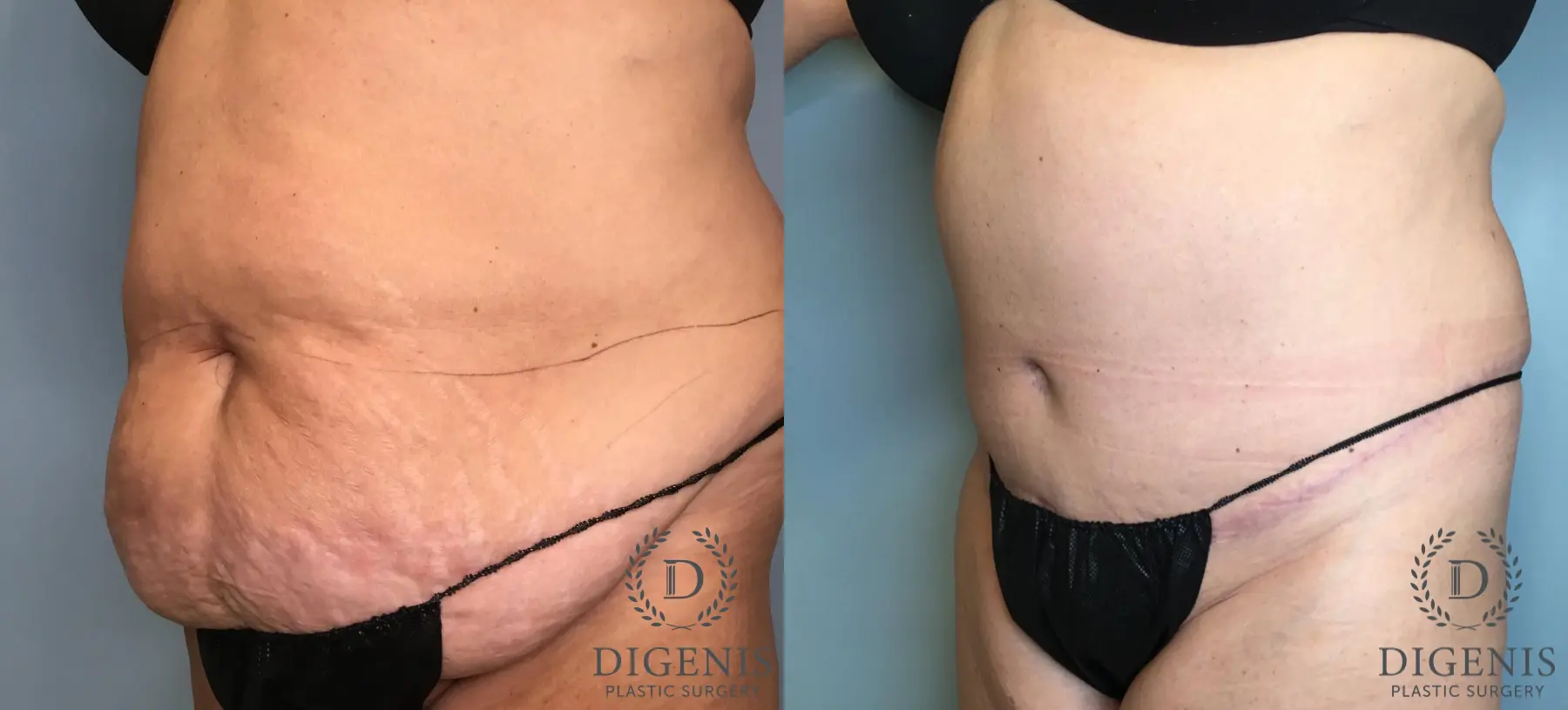 Tummy Tuck: Patient 1 - Before and After 2