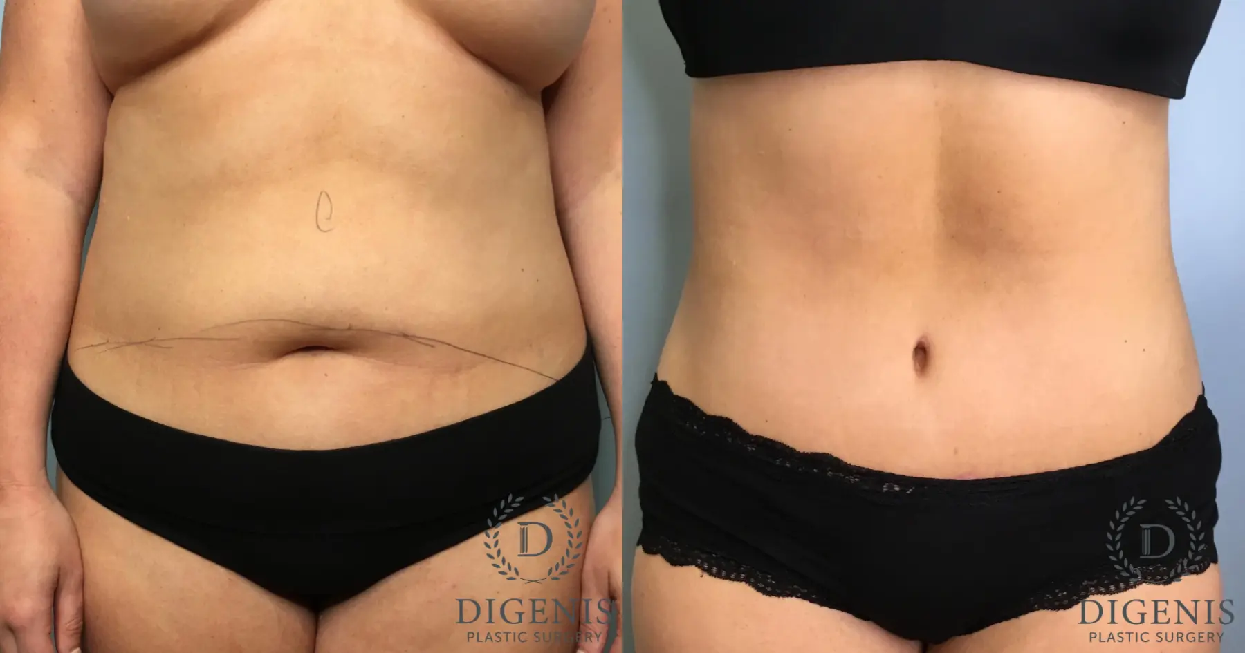 Tummy Tuck: Patient 33 - Before and After 1